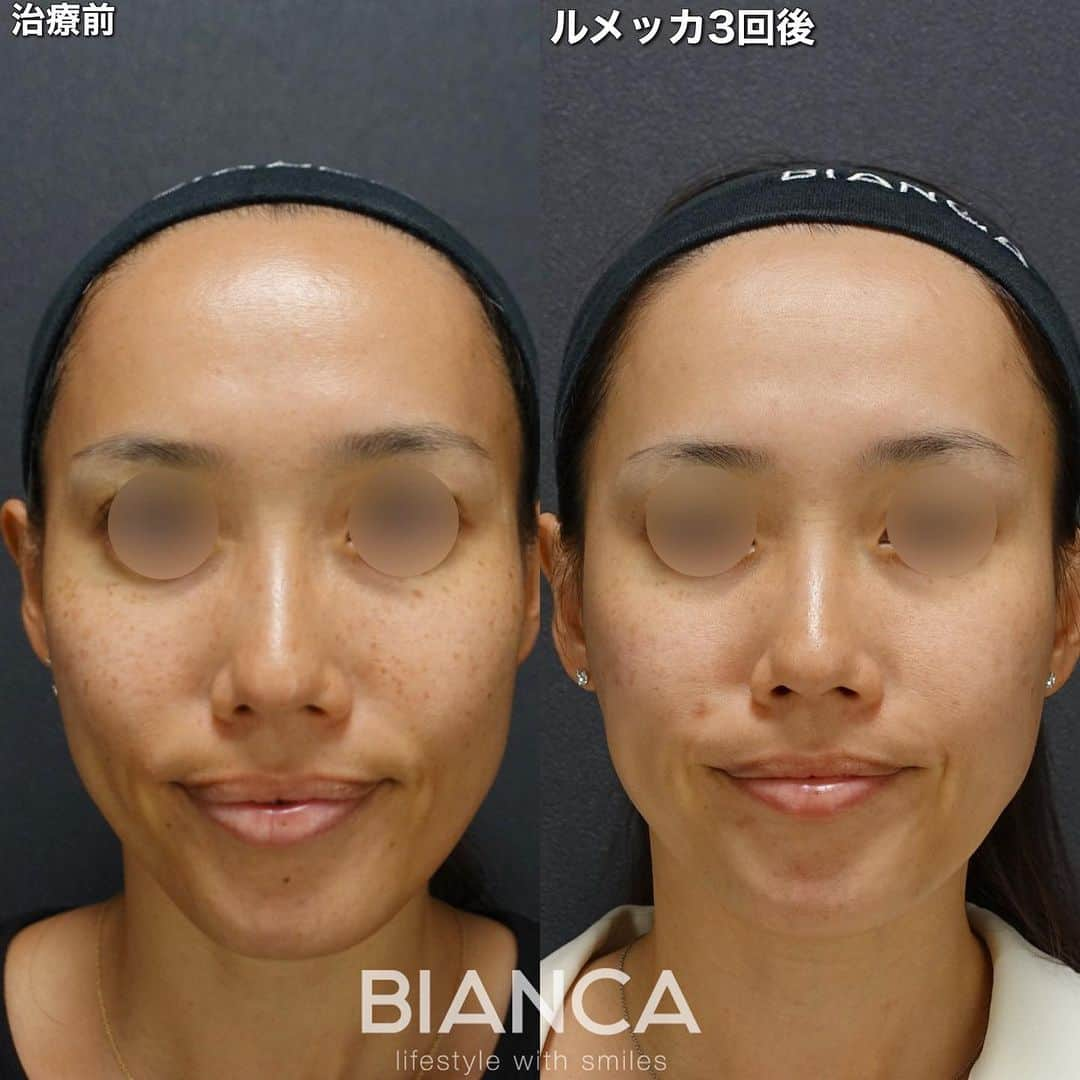 辻沢由有（BIANCA CLNIC 表参道院 院長）さんのインスタグラム写真 - (辻沢由有（BIANCA CLNIC 表参道院 院長）Instagram)「【ルメッカ3回後✨】 ▶︎swipeで別角度＆文字無し写真▶︎  ルメッカ3回照射後の症例です。 シミが改善され、お肌全体がトーンアップ✨またご本人のご実感も非常に高いです❣️  ルメッカはイスラエルInMode社の超高性能光治療機器。 アメリカFDA認可の製品で、 シミ・くすみ・そばかす・ 赤ら顔毛穴などの肌質改善や、肌の若返りの効果が 期待できる光を活用した最新型IPL機器です✨  ーこんな方にオススメー ☑顔全体のシミやそばかすを除去したい ☑ 毛穴や赤ら顔を改善させたい ☑ 肌にハリが欲しい ☑ くすみのない明るい肌になりたい ☑ メイクノリを良くしたい ☑ シミの再発防止をしたい ☑ 美肌を維持させたい  【通常1回】27,280円＋税 【ｺｰｽ 6回】 130,680円＋税 ※1回あたり19,800円＋税  最新の優れた美肌治療であるルメッカは、 メラニンへの吸収率が高いとされている500～600nm 短波長域光線をより多く照射するよう特別に設計されて おり、従来のIPL治療よりも約３倍の効率で照射するため 美肌への効果が高いとされています❣  有効な光エネルギーを照射することで、光と熱の作用に より、肌のコラーゲンやエラスチンの再生が促進されます。  その結果、気になるシミ・くすみ・毛穴・赤みを改善し、 ハリ・弾力も回復させ、透明感のある理想の美肌を 目指すことができます❣  定期的に施術を受けることで、理想の美肌になるだけで なく、肌に潜むシミ予備軍の予防としておすすめです✨  #ルメッカ#ipl#フォトフェイシャル#赤ら顔#シミ#ニキビ痕#皮膚科専門医#ニキビケア #赤み消し」5月29日 16時00分 - i_am_yuu__