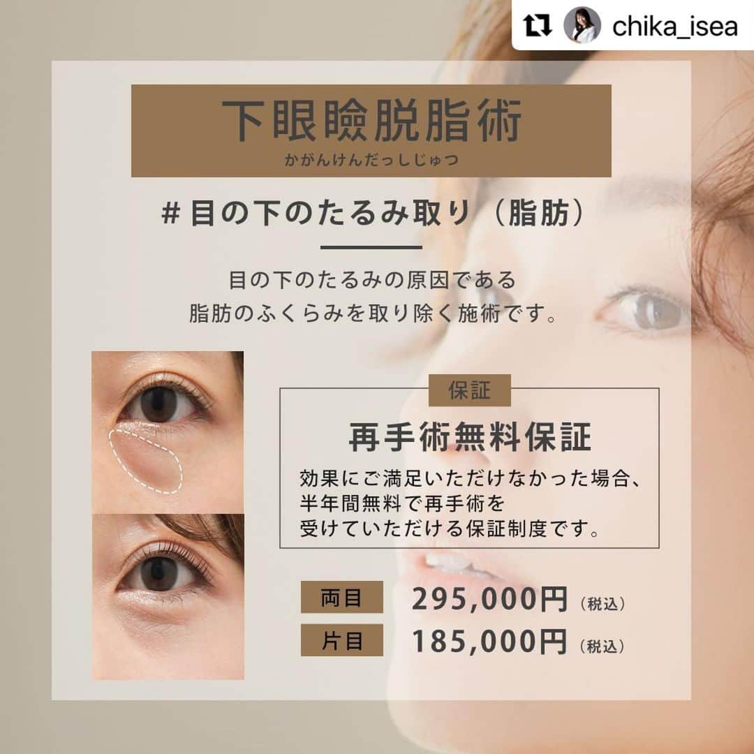 東京イセアクリニックさんのインスタグラム写真 - (東京イセアクリニックInstagram)「#下眼瞼脱脂術  #目の下のたるみ治療（脂肪）  ▼執刀医 医学博士・形成外科専門医 Dr. 鈴木知佳  @chika_isea   ▼詳細  Before・・・術前 After ・・・1か月後  【施術の詳細】 🕐手術時間 ・・・約1時間 👁ダウンタイム・・・約1週間 📆完成まで ・・・約3か月 🏥術後の通院　・・・2回（1ヶ月検診、3ヶ月検診）  【下眼瞼脱脂術とは？】 目の結膜部分（アッカンベーをしたときに出る赤い粘膜部分）から、目の下の膨らみの原因となる脂肪を取り除く施術です。  【こんな方におすすめ！】 ✔️目の下のたるみを改善したい方 ✔️目の下の膨らみが気になる方 ✔️目の下のクマが気になる方  【保証について】 ・再手術無料保証 効果に満足いただけなかった場合、6ヶ月間無料で再手術を受けていただける保証制度です。  【リスクについて】 凹み、くぼみ、感染、左右差が生じる、小ジワや皮膚のたるみが目立つ可能性  ---------------------------  ▫️術名 下眼瞼脱脂術 ー目の下のたるみ取り（脂肪）  ▪️料金 両目　295,000円(税込)  (麻酔費・痛み止め費・再施術費込み)  ⏩目の下のたるみ治療だけの 症例写真やお役立ちコンテンツを毎日更新！ 『　@menoshita＿isea　』 ご質問がある方はお気軽にDMして下さい🙋‍♂️  #目の下のたるみ #目の下のクマ #目の下のたるみ取り #目の下のたるみ治療 #目の下クマ治療 #目の下のクマたるみ治療 #下眼瞼脱脂術 #イセアの目の下のたるみ治療 #経結膜法 #下眼瞼除皺術 #ハムラ法 #美容外科 #美容外科医 #美容クリニック #美容整形 #目の下 #目の下の改善 #目の下のクマ改善 #目の下のふくらみ取り #目の下のふくらみ #目の下の脂肪 #目の下整形 #東京イセアクリニック #イセア #ISEACLINIC #吉種克之 #鈴木知佳」5月30日 11時58分 - iseaclinic