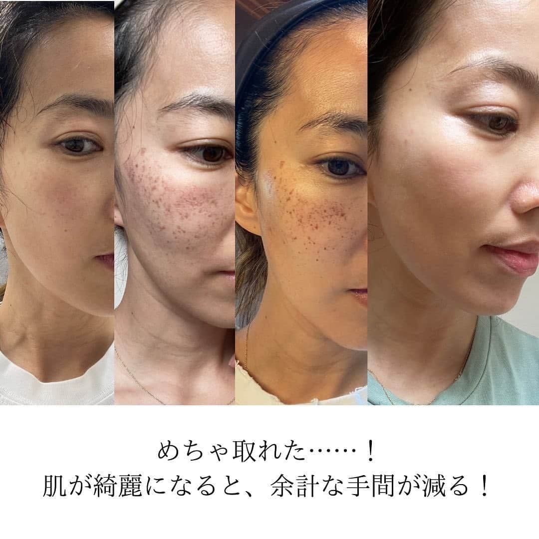 菅井悦子さんのインスタグラム写真 - (菅井悦子Instagram)「私の実録、二年ぶり、第二回シミ取り結果🎤  よーーーく取れました🤣✌️  そりゃぁ毎日のように散歩に出て、 週末は太陽の下、犬と子供と遊んでたら、 どんなに日焼け止めを塗ってても（しかも塗り直しなんてしない🫣）、焼けるし、シミも出てきます。 潮干狩りも行くしね……😅  だから、もうね、、 医療の力に頼るのが早い！  今回も広尾にあるスキンフィニティクリニックにて、先生が的確に施術して下さいました。  二年ぶりのマシンは、正直な話、 うう😭と半べそかくほど痛い😰 多分、夫は耐えられない😂  でも長い時間バチンバチンと当てる訳では無いので、まぁ、耐えられます。  だってこんなに綺麗になるんだもん🤗 耐えますよ！  毎日が楽🥹 くすみが取れて、いい感じ！  私の場合は、 また来たくなったら来てください🙌 というスタンスですが、 一気に取りたい人もいるだろうし、 シミの種類によっては何回か通った方がいい場合もあると思います。  私がやったのは、M22という機械のもの。  詳しくは分からないのでドクターに相談の上、進めてくださいね。  @skinfinity_staff @dr_satoshi_hashimoto_   もちろん#自腹です #PRではありません #ただの実録#私のシミ取り実録  ご参考になれば！」5月30日 12時41分 - etsuko313