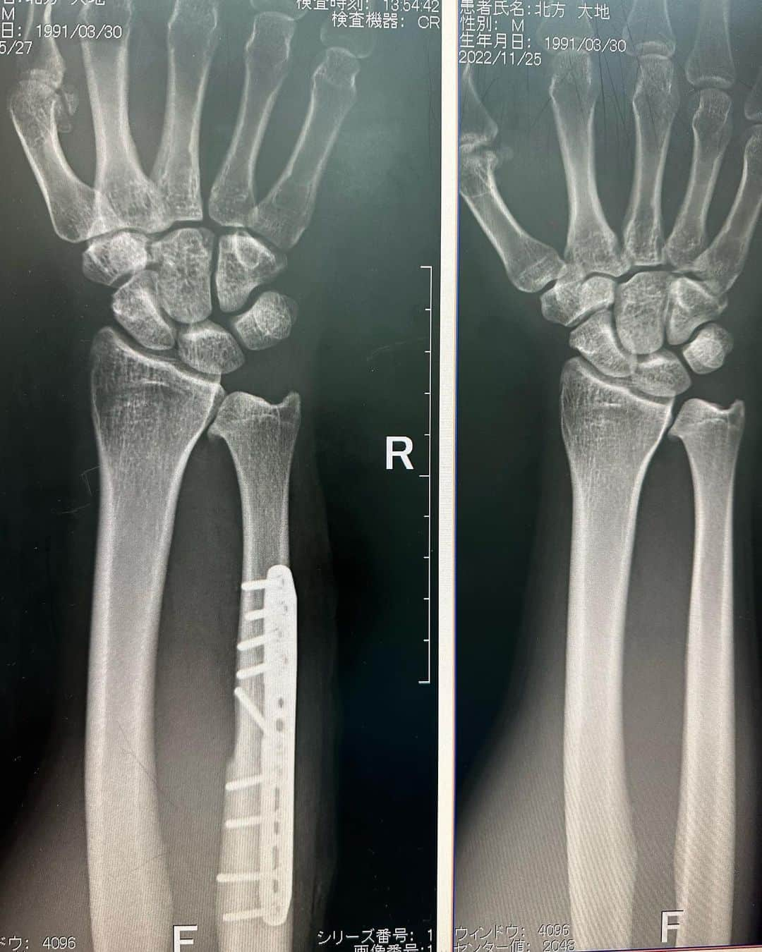 北方大地のインスタグラム：「全治半年の手術を受けたのは、最高の状態で闘うため。  覚悟の上の決意です。  カムバックを楽しみにしていただけるとモチベーションになります🔥」