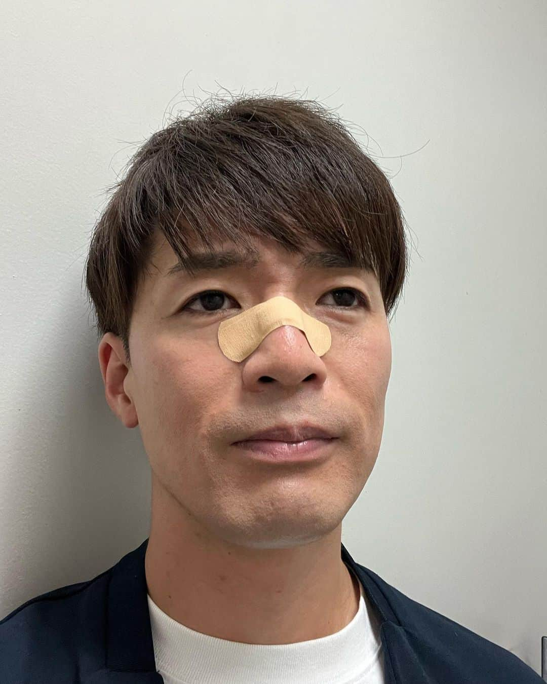 辻井亮平さんのインスタグラム写真 - (辻井亮平Instagram)「4日連続幕張ありがとうございました！  今日が最終日でありました！  僕はこの幕張4連チャンの事を【幕張Camp】と勝手に呼んでいました。  フェスやと思って頑張りました！  Camp中に単独チケット買って下さった方々もありがとうございました！  Camp最終日の最終公演ではネタ中、ギターを取りに袖ハケてギターを掛ける時にギターが鼻にガチーン！当たって一瞬頭に星が回るほど痛かったけど、ネタ中やしとりあえず出なあかんしそのままネタやってました。  ほなナポリ先生の目がどんどん点になっていくのが分かって、何や？！思うて終わって袖ハケたらすぐナポリ先生に、  『…血ぃ出てる…。』  と言われました。それでか！  鏡見に行ったらめちゃくちゃ流血してました！配信なくてよかった！！！前列のお客さんも怖かったやろ、、、！！ごめんなさい🤣  何してんねん！！！  単独まであと2日！！  衣装どころか鼻が間に合わない可能性も出てきました！！  申し訳ありませんが、よろしくお願いします！！  明日は大宮ロビーで最後の単独手売りをする予定ですので是非よろしくお願いします！！  #ほんまケガって #どこに潜んでるか分からんよなぁ #このままコーナー出ました #恥ずかしい #どうしたん急に ？！ #って聞かれて #ニキビが潰れちゃいました 🥰 #年頃なので 🥰 #って返したら #めっちゃスベりました #いやぁ〜 #怪我よりそっちの方が痛かったよなぁ 〜 #山さん」6月1日 20時41分 - aironhed_tsujii