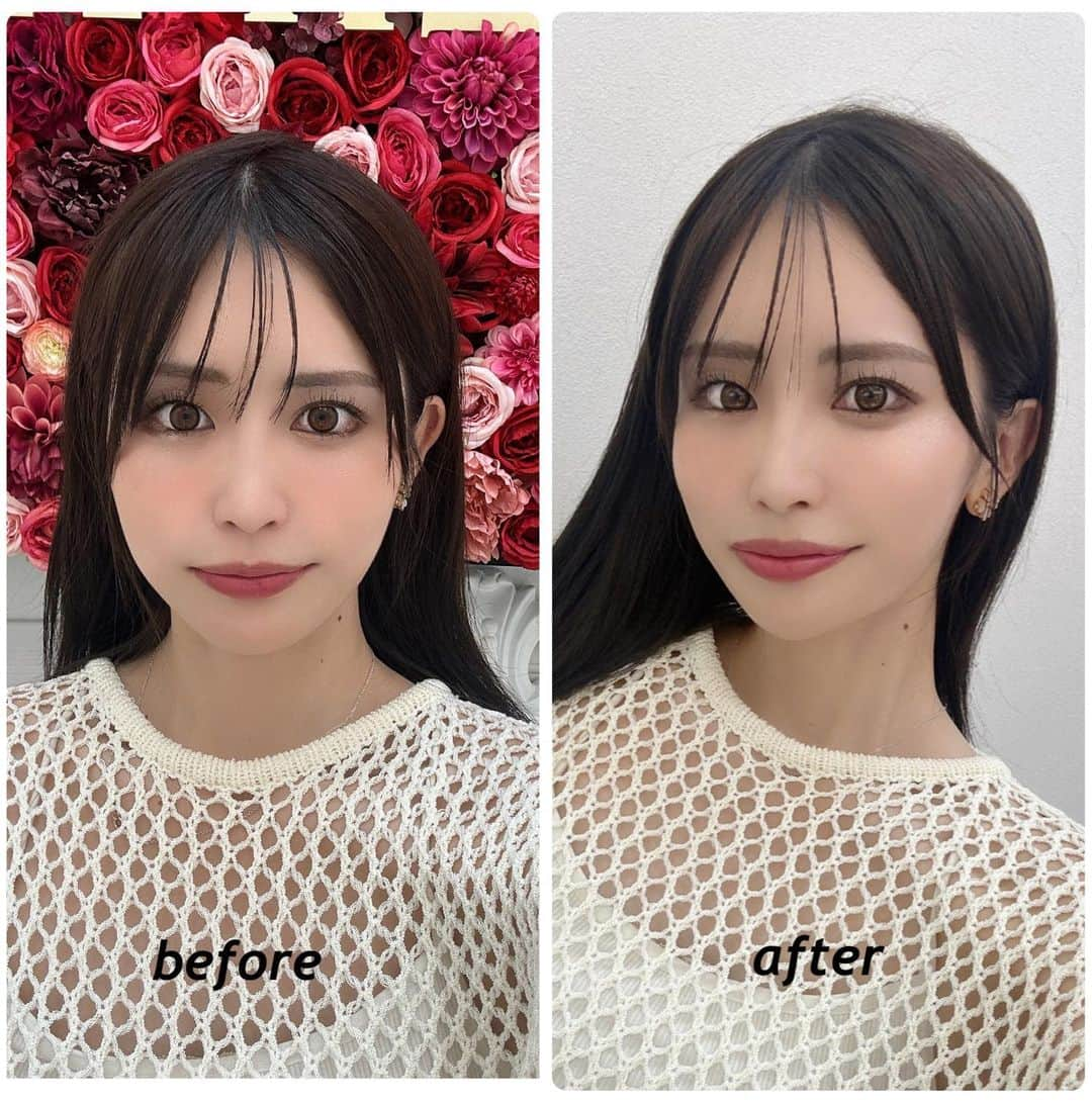 織田真実那さんのインスタグラム写真 - (織田真実那Instagram)「@aclinic_shinjuku で 戸田先生（@aclinic_toda ）にAスレッドを施術して頂きました✨  直後から、気になっていた顔のもたつきがが改善されました✨  戸田先生にAスレッドを施術していただくのは二度目なのですが、  ここはあげて欲しいここは上がらないでほしいなどのカウンセリングもしっかりして頂いて、毎回理想の通りにしてくれて本当に感謝です✨🥺  院内も綺麗でスタッフの方も丁寧に対応していただきました🤍  また半年後以降にAスレッドをやってもらいたいです✨  #aスレッド #糸リフト #aclinic #aclinic銀座 #aclinic横浜 #aclinic新宿 #aclinic名古屋 #aclinic大阪 #aclinic福岡#aclinic池袋 #aclinic仙台 #aクリニック #エークリニック #小顔 #スレッドリフト #小顔整形 #たるみ改善   #リフトアップ #美容外科 #美容皮膚科 #美容クリニック#戸田貴之」5月9日 20時40分 - omamechan_m