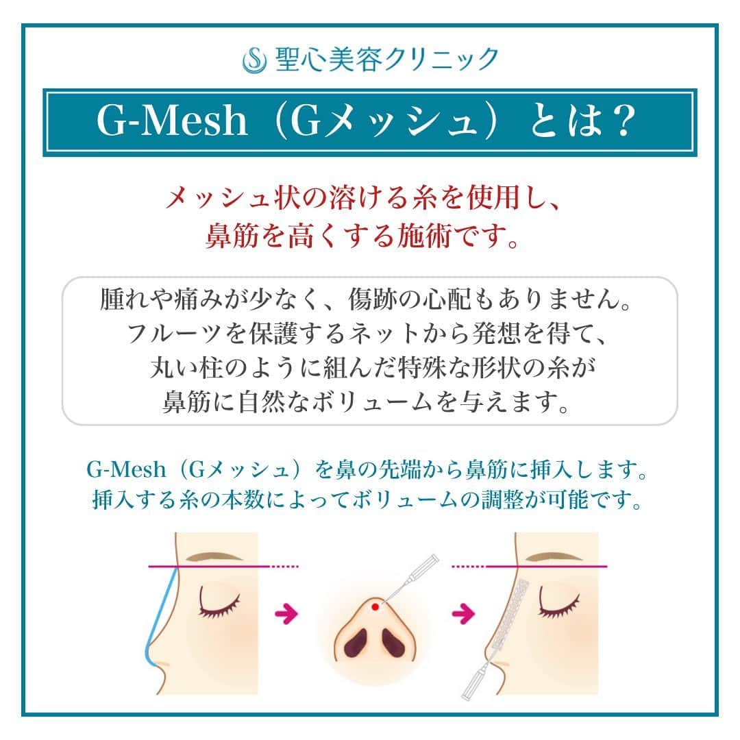 聖心美容クリニック公式アカウント さんのインスタグラム写真 - (聖心美容クリニック公式アカウント Instagram)「. ＼20代G-Mesh（Gメッシュ）🌟鼻筋が綺麗に通りました💖／  20代女性です。 聖心美容クリニックのG-Mesh（Gメッシュ）を 受けていただきました💓  G-Mesh（Gメッシュ）とは❓ メッシュ状の溶ける糸を使用し、 鼻筋を高くする施術です。  腫れや痛みが少なく、傷跡の心配もありません。 フルーツを保護するネットから発想を得て、 丸い柱のように組んだ特殊な形状の糸が 鼻筋に自然なボリュームを与えます🧑‍⚕️  After施術直後です❗️ 鼻筋が綺麗に通りました💖  症例紹介アカウント（ @seishin_beforeafter ）で他の症例もチェックしてみてくださいね💕  一人ひとりのご希望に寄り添う丁寧なカウンセリング🏥 あなたの悩みに最適なオンリーワンの施術を🌷 聖心美容クリニックの無料カウンセリングは下記からお気軽にご連絡ください✨  ･+････+････+････+･･ 📲WEB予約：プロフィールからリンクをクリック　@seishinbiyou 📞電話予約：0120-112-614 🍀LINE予約：「聖心美容クリニック」で検索 ･+････+････+････+･･  --------------------------- 👨‍⚕️担当医 横浜院 熱海院 S-Labo医師 川守田 詩乃@seishin_kawamorita  💉施術名 G-Mesh（Gメッシュ）  🌱施術内容 カニューレで麻酔し、PCLメッシュ（2年持続）挿入。  ⚠️リスク・副作用 浮腫、痛み、内出血、アレルギー反応、 感染、露出、挿入部の瘢痕化。  💰費用 206,800円（税込） ---------------------------  #鼻筋 #鼻整形 #団子鼻 #鼻  #美容クリニック  #美容整形  #美容医療  #美容皮膚科  #とことん真面目に美容医療  #聖心美容クリニック #聖心美容クリニック横浜院  #聖心美容クリニック熱海院」5月10日 17時03分 - seishinbiyou