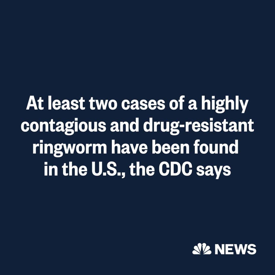 NBC Newsさんのインスタグラム写真 - (NBC NewsInstagram)「Two cases of highly contagious, drug-resistant ringworm infections have been detected in New York City — the first such cases ever reported in the U.S., the CDC says.  The infection was first identified in a 47-year-old women who had developed a bad case of ringworm, also known as tinea, while traveling in Bangladesh.  Read more at the link in bio.」5月12日 2時10分 - nbcnews