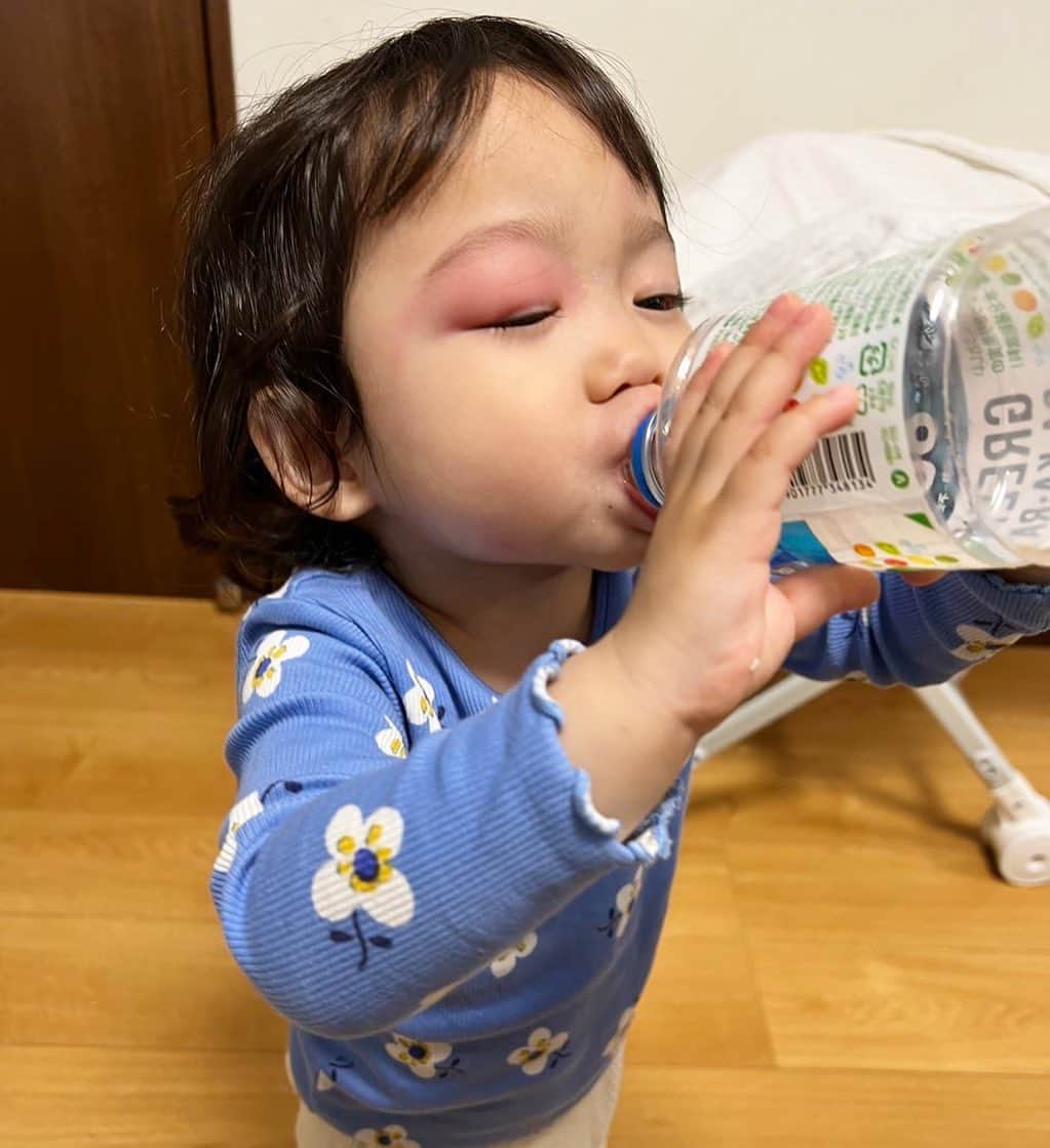 ゆうひなたのインスタグラム：「. . . 朝からびっくり！！！😱 蚊の仕業です🦟 許せない。。。😠😠😠. . . リアルのどうぶつの森に なってしまいました😣. . .」