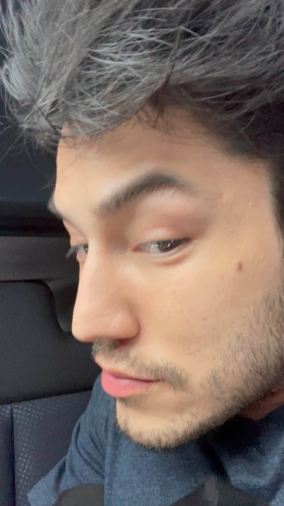 アルトゥール・オヤカワ・マリアノのインスタグラム：「Quem me acompanha sabe que no ano passado eu quebrei meu nariz na barra durante o treino. Faço acompanhamento com meus médicos e médico otorrino, me recuperei em partes, estou ajeitando aos poucos. Desta vez eu vim fazer o preenchimento que a lesão causou. Procurei um procedimento mais simples para não causar muita invasão, devido ao preparo e condicionamento físico que preciso ter para as competições.   Obrigado Dr. Monica e Clínica Suganuma, daqui 4 meses estamos de volta! @dra.monicasuganuma  @clinicasuganuma  * * *  *Consulte seu médico.」