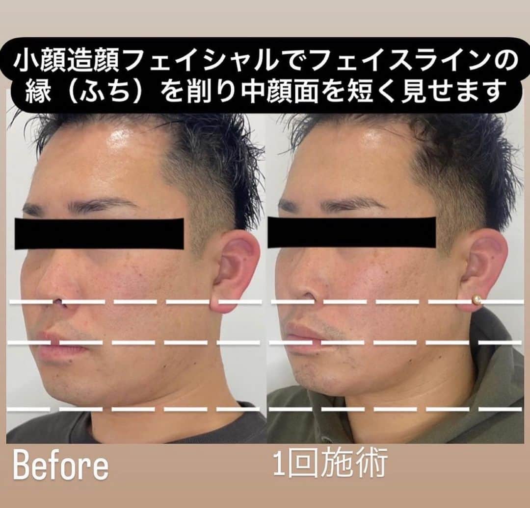 角森脩平のインスタグラム：「. 中顔面を土台から短くする技術🤗 担当 西田沙織　@saori_kadomori_osaka  #KADOMORI#カドモリ#ビオーラ#viola#中顔面#中顔面短縮#顔の長さ#小顔矯正#リフトアップ」