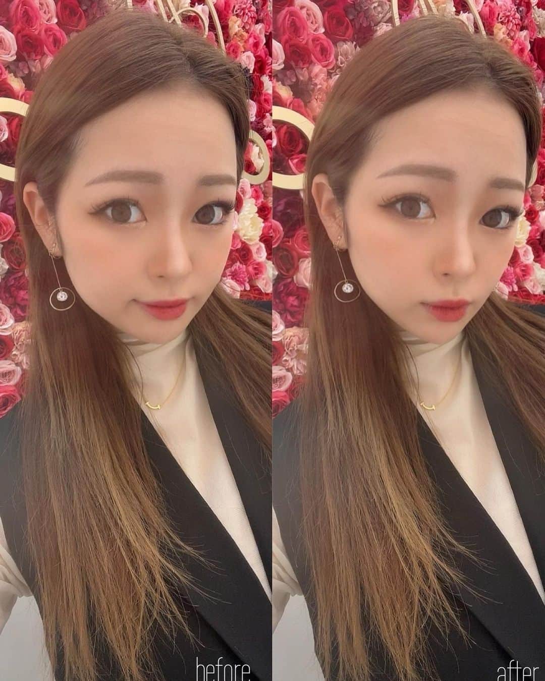 KEIさんのインスタグラム写真 - (KEIInstagram)「. . . . 先日投稿した @a_clinic_nagoya の住田先生( @aclinic_sumita ) の1day小顔脂肪吸引施術から数日、、！ 腫れも引いてきて引き締まってきた感じ😌✨  とは言っても、最初からそんなに腫れもないし、 術中の痛みもほぼなかったんだけどね🤣 だから本当に寝て起きたら顔がシュっとした感じ！！  顔の浮腫みやもたつきに気になってる方いたら ほんとにおすすめの施術だから是非🫶💕 私もまた浮腫みに気をつけつつ、Aスレッドで定期ケアしていきたいなと思います☺️  "#aclinic #aクリニック #エークリニック #aclinic銀座 #aclinic横浜 #aclinic新宿#aclinic名古屋#aclinic大阪#aclinic池袋#aclinic福岡#aclinic仙台 #美容外科 #美容皮膚科 #1day小顔脂肪吸引 #1day小顔  #脂肪吸引 #小顔 #美肌 #二重あご #フェイスライン #糸リフト #aスレッド #顔痩せ #部分やせ #小顔整形 #小顔になりたい#横顔美人 #住田篤紀」5月15日 20時24分 - kei_oktwins