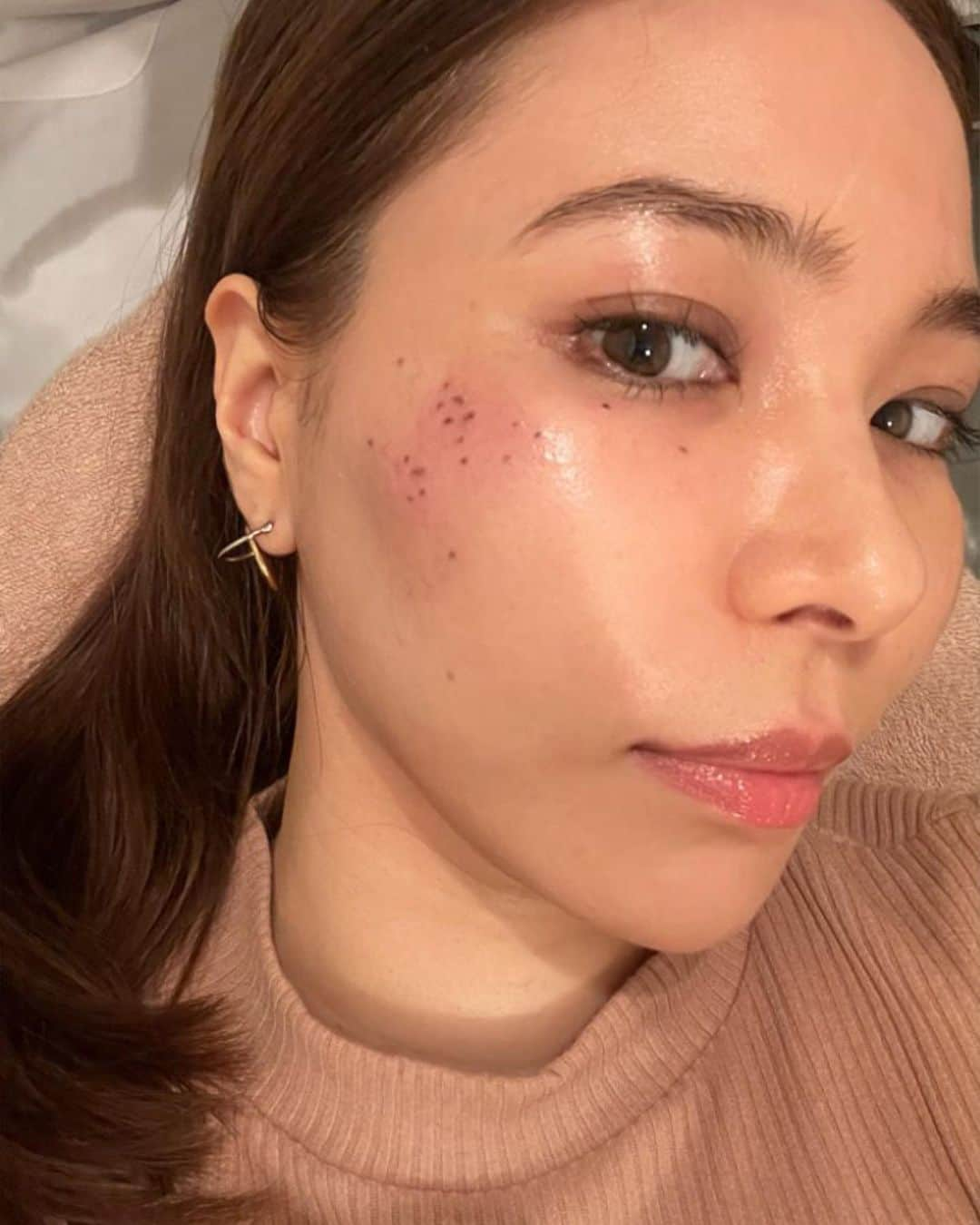 エリカ・セイラさんのインスタグラム写真 - (エリカ・セイラInstagram)「六本木にある @cbeauty2014 サロンでシミDetox ターンオーバー促進施術をしてきたよ🤍20ショット打ってもらった🤍  シミ・くすみ、ニキビなどの炎症による色素沈着などの予防・改善にもなるし、目の周りや、まぶたも施術も可能なのがありがたい🤍  直後は打ったところのシミが黒くなって、1週間後くらいにかさぶたになって自然と剥がれるみたい🤍  #cbeauty株式会社 #PR #幹細胞化粧品 #アンチエイジング化粧品 #ヒト幹細胞エステ #ノーファンデ生活 #シミ #シミ取り」5月16日 15時44分 - erica_sarah_