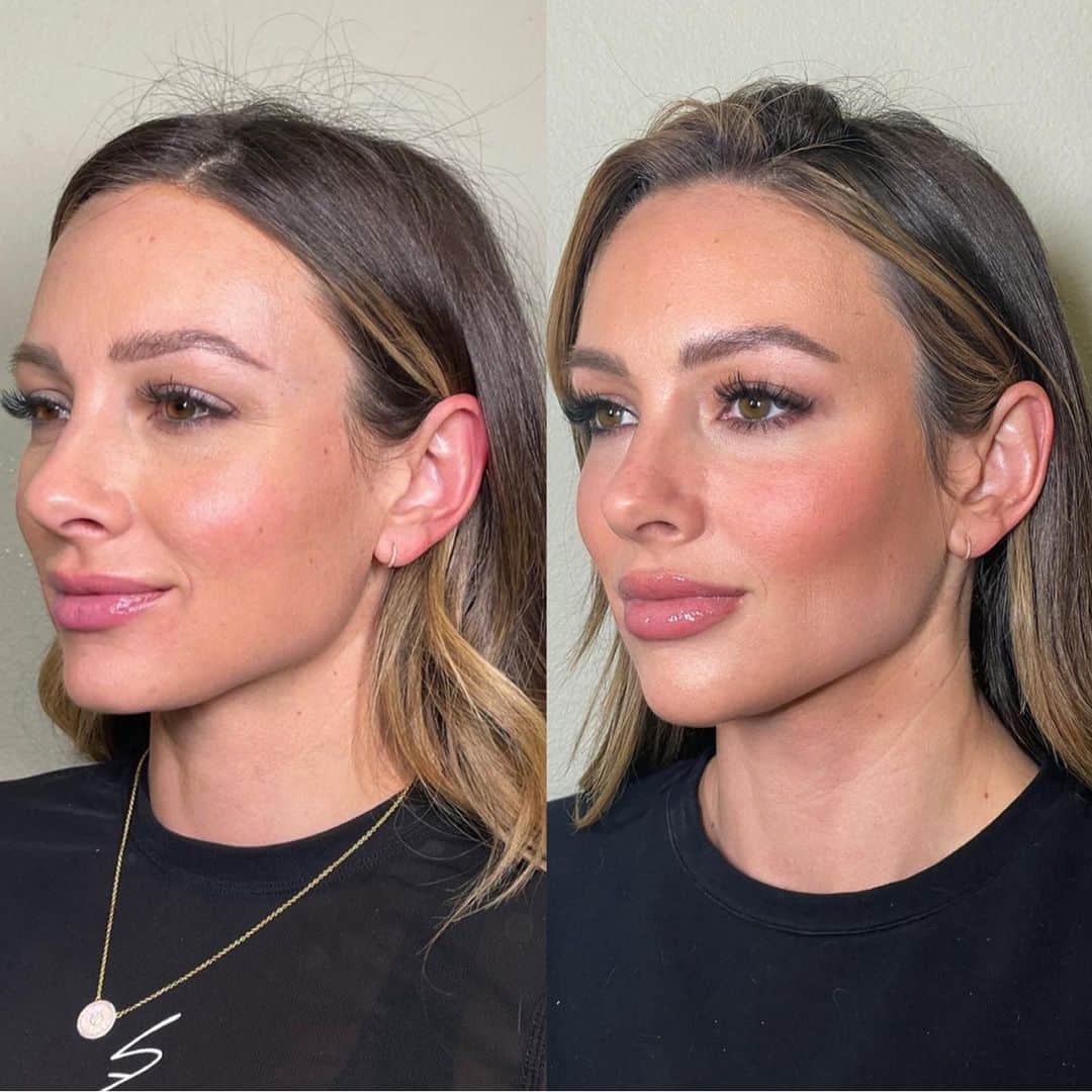 Paige Hathawayのインスタグラム：「Full facial balancing and taking even better care of my skin. ✨ @rebeccanosebest  I’M STILL IN SHOCK BY THESE PHOTOS!😳 Before: Left | After: Right | WHAT DO YOU THINK…?   My goal is just to enhance my natural beauty while I age.. being 35 (almost 36) as I’ve gotten older, I’ve realized I’ve lost some volume in my face and my wrinkles are a bit deeper. They have gotten especially bad in my forehead area (not shown) maybe because I used to wear a backwards hat so much in my 20s 😂   We injected chin, lips, cheeks, and dysport.   We used dysport in my areas in which fine lines and wrinkles are more pronounced (my forehead) and then we added fillers to my chin, lips and cheeks for more volume and erase wrinkles caused by volume loss!  I’ve never done my chin before but I LOVE how it helped balance out my profile a bit more.   Rebecca also started me on a retinol (which I had never been on and saw a immediate different in my skin… 10/10 highly recommend. I linked the one I’ve been using in my bio) with 4 week difference between photos!」