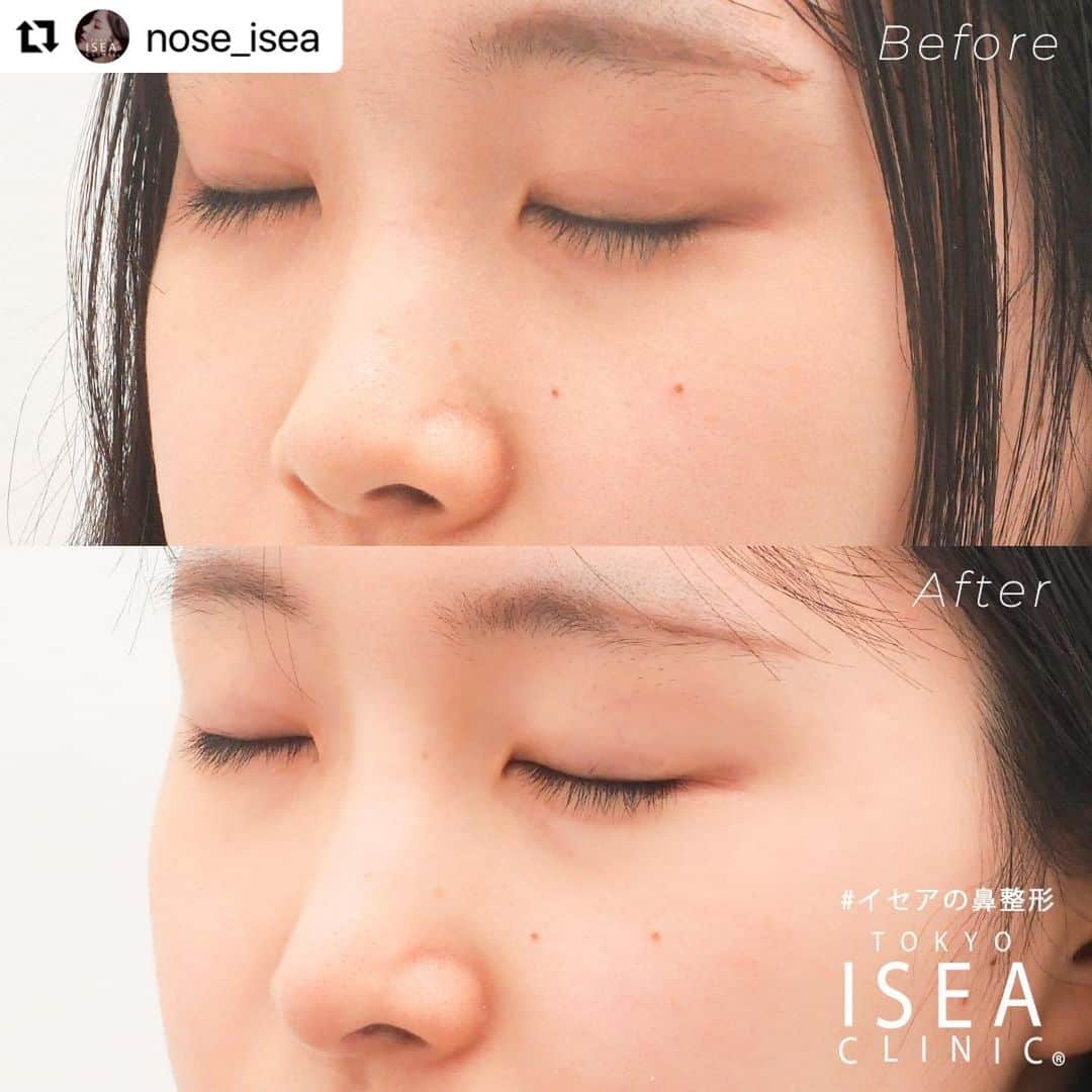 東京イセアクリニックさんのインスタグラム写真 - (東京イセアクリニックInstagram)「■鼻の複合施術  #プロテーゼ隆鼻術  #鼻尖形成（耳介軟骨移植）  術前と1か月後の比較です。 ⁡ ▼執刀医 形成外科専門医・医学博士 Dr. 酒井新介 @sakai.s_isea  ⁡  ▼詳細 こんな方におすすめの整形 ・鼻筋を通したい方 ・鼻尖の丸みを無くしたい方 ・だんご鼻を解消したい方 ・半永久的に効果を得たい方 ⁡ 【施術】 プロテーゼ隆鼻術→308,000円(税込) 鼻尖形成（耳介軟骨移植）→418,000円(税込)  ※鼻の整形を2つ以上同時に受ける場合、合計金額より10%オフになります。  【ダウンタイム】 腫れ・内出血・痛み→約2週間 完成→約3カ月 ⁡ 【リスクについて】 血腫・腫れ・感染の可能性がある・瘢痕（はんこん）・内出血・鈍痛・違和感 ⁡ ⁡ ご予約・お問い合わせは、プロフィール欄の URLからお願いします！ ⁡ #鼻整形 #イセアの鼻整形 #だんご鼻解消 #プロテーゼ隆鼻術 #鼻尖形成 #耳介軟骨移植 #団子鼻 #美容整形 ⁡#東京イセアクリニック #イセアクリニック #ISEACLINIC #イセア #ISEA #酒井新介」5月18日 12時34分 - iseaclinic