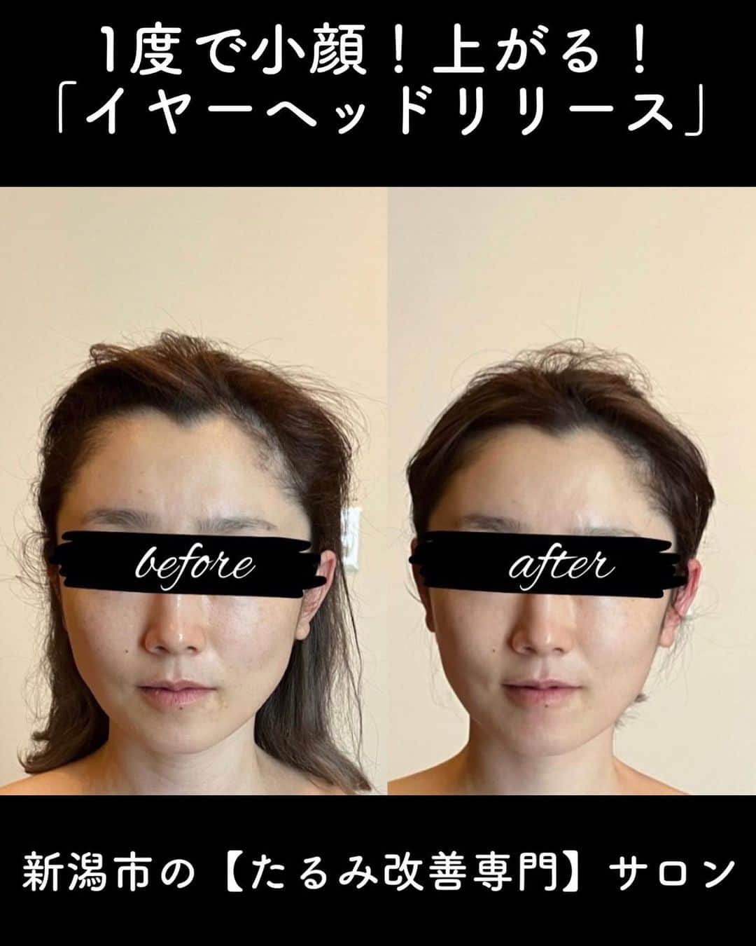 新海史子のインスタグラム：「【イヤーヘッドリリース】  ↑最近一番感動したエイジングケアです。  ビフォーアフターを見ての通り。  浮腫んで重たかった顔面が一度でスッキリ。 フェイスラインがハッキリして、埋もれてた顔のパーツが出てきた！w  抱き枕抱えてベッドに横になるスタイルで (楽ちんで早くも寝そう)  耳を温めながら、ツボを刺激したり内側外側細かいところまでマッサージ。　  頭皮や首、肩、リンパ等もマッサージ。  気持ちよくてリラックス効果抜群。 ほぼ寝てました。  色々な小顔、たるみケアがあるけど 痛くなくて、ただただ気持ちいいだけなのに このリフトアップ効果は驚き。  即効性があるので大事な日の駆け込み寺になりそう。  終わってお化粧したら、加工なしで盛れました。w  耳って凄い。  ここ最近で一番驚いた美容法でした。  【イヤーヘッドリリース】  新潟市西区の【たるみ改善専門】サロン イヴ トリコ(Eve Trico)さんで受けられますよ~  #新潟美容 #イヴトリコ #イブトリコ #たるみ改善 #エステ #イヤーリリース調整新潟」