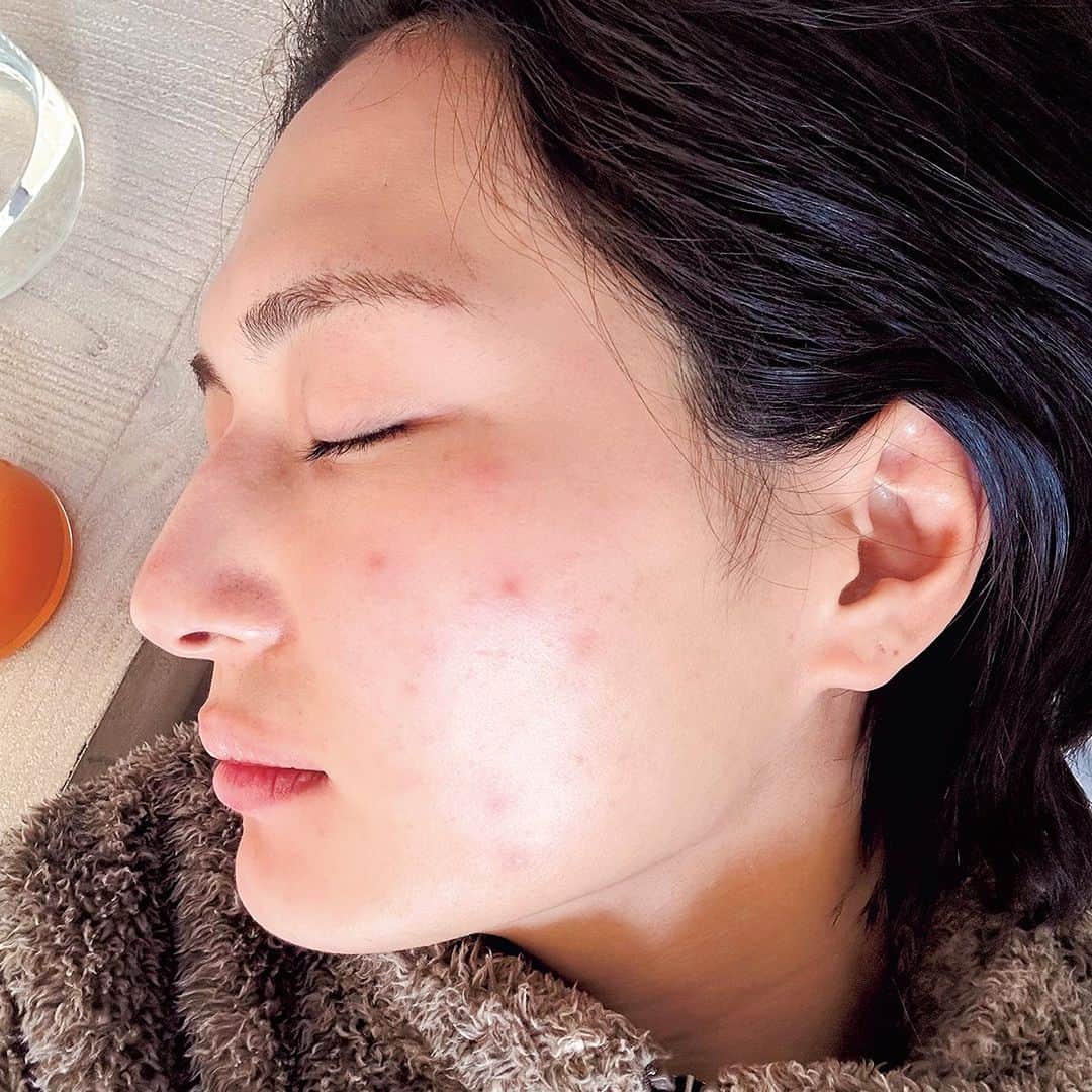 美的 Biteki's official Instagram! さんのインスタグラム写真 - (美的 Biteki's official Instagram! Instagram)「＼山賀琴子さんの毛穴克服3か条／ 「肌がゆらいだ時こそ体の中からコンディションを整えます」  山賀琴子さんは、毛穴とは無縁なのはもちろん、羨ましい程つるっつるに輝く美肌のもち主。 けれども実は、3か月に1回のペースでハードに揺らぐ、敏感肌だそう。  「就職をきっかけに、ゆらぎ肌へ。ゆらいだときは化粧水の浸透が悪くて肌がゴワつき、毛穴も開きがち。肌あれが原因でメンタルが落ち込んだ過去もあるけれど、肌あれも毛穴もみんなにあるし、今はいい意味で気にしすぎません」（山賀さん）  ゆらぎやすい肌に合わせ、スキンケアは“できるだけシンプル、かつ丁寧に保湿”がモットー。 その一方で、ゆらいだときこそ食事の品数を多くし、体の中からコンディションを整えるようにしています。  ＼毛穴History／ 10代：最強ヘルシー肌！ 夜更かししても肌があれず、スキンケアをサボっても毛穴レス。時々できる毛穴の詰まりをピンセットで抜くのが快感になる。 ↓ 18歳：メイクに覚醒し、肌質が変化（写真2枚目） 大学生になり、メイクを本格的に開始！　けれどもメイク落としはテキトーで、吹き出物ができやすくなるなど徐々に肌質が変化。 ↓ 22歳：就職で肌あれ発生 環境の変化などが起因し、肌が真っ赤に腫れたり、吹き出物がたくさんできたり、水でも染みたり…etc. 揺らぎ肌に悩むように。 ↓ 24歳：保湿剤のみで半年過ごす 4か所の皮膚科に相談するも治らず、処方された保湿剤のみを塗り、メイクも仕事で必要なとき以外はしない生活を約半年間送る。 ↓ 26歳：マスク生活で毛穴が悪化 2年前の肌あれと、肌あれによるメンタル不調をもち直したところでコロナ禍に。マスクで肌が蒸れることで、毛穴の開きが悪化。 ↓ 現在：揺らぎやすいけれど、復活！ ライフスタイルからの見直しも図り、少しずつ毛穴レス美肌に。揺らぐこともあるけれど、落ち込まない強いメンタルも今はゲット。  ＼山賀さんの毛穴克服3か条／  【1】クレンジング前のスチーマーを日課に  「パナソニックのスチーマーを10分程浴びて毛穴を開いてからクレンジングを行うのがマイルール。メイクがするっと落ちるようになり、毛穴詰まりも激減しました。」  3枚目 手もちの化粧水を微細化して噴射できる「化粧水ミスト機能」も搭載。 パナソニック スチーマー ナノケア　EH-SA0B　￥50,000（編集部調べ）  4枚目 ＼クレンジングと洗顔はコレが好き！／ 左／毛穴汚れを吸着する備長炭配合のクレンジングバーム。すっきりみずみずしい洗い上がり。 クリニーク テイク ザ　デイ オフ クレンジング バーム　チャコール 125ml　￥4,840  右／ボリューミーな泡立ちとしっとりとした洗い上がりが特徴の自然派洗顔料。 THREE バランシングネクター クリーム ウォッシュ　100g　￥4,290  【2】スキンケアはシンプルステップで丁寧になじませる  5枚目 ＼化粧水は最低3回重ねづけします／ 「あれこれ重ねすぎると刺激を感じることもあるので、デイリーケアは化粧水、美容液感覚で使えるミスト、オイルのみ。１ステップごとにハンドプレスをして、きちんとなじませます。」  6枚目 ＼肌がほっとするような使用感♪／ 左／ゴワつきがちな肌をほぐす。ブースターや美容液としても使える。 マツキヨココカラ&カンパニー アルジェラン オーガニック認証 セラムオイル 30ml　￥2,178  中／EGFやCICAなど、話題の美容成分を高配合。 レカルカ ブライトリー　モイストシャインミスト 120ml　￥7,920  右／深くまでなじんで潤う、とろみ化粧水。 マツキヨココカラ＆カンパニー アルジェラン オーガニック認証 高保水化粧水 180ml　￥1,650  【3】バランスの良い食事を心掛け、体の中から毛穴目立ちを予防！  7・8枚目 ＼品数はできる限り多めに／  9枚目 ＼イマイチなときはサプリも投入♪／ 左／吸収＆浸透量にこだわり、ビタミンCを国内製造でリポソーム化して配合した、液状サプリメント。 スピック Lypo-C 30包入り　￥7,776  右／美容と健康、それぞれに効果的な3粒が1包に集約されたマルチサプリ。 タカミ タカミサプリ 15包入り　￥4,200  PROFILE やまが ことこ／2015年・ミス青山グランプリに輝く。アクセサリーブランド「ENELSIA」のデザイナー兼経営者であり、YouTubeチャンネル「山賀琴子のコトコトチャンネル」が人気。’95年生まれ。  #山賀琴子 #毛穴ケア #スキンケア #新作コスメ2023 #新作コスメ #春コスメ2023 #bitekicom #コスメ好きさんと繋がりたい #メイク好きさんと繋がりたい #美容 #美的 #美的メイク #メイク好き #美ボディ #女子力向上委員会 #美容好きな人と繋がりたい #コスメ #美肌 #コスメオタク #美肌になりたい #美容好きさんと繋がりたい #美意識高い人と繋がりたい #コスメ好きな人と繋がりたい #美容垢さんと繋がりたい #メイク好きな人と繋がりたい #美活」5月19日 21時00分 - bitekicom