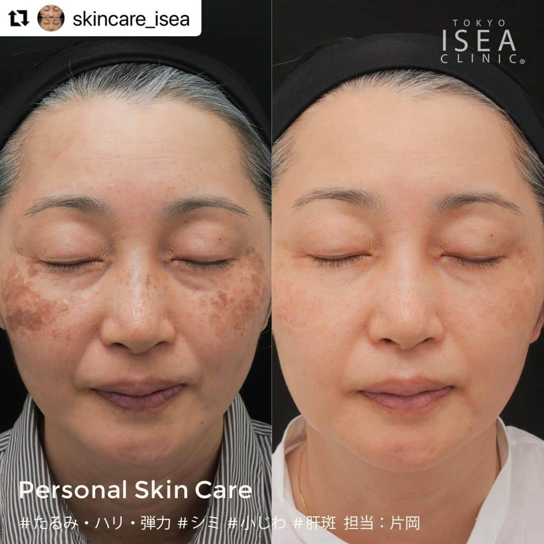 東京イセアクリニックさんのインスタグラム写真 - (東京イセアクリニックInstagram)「【Personal Skin Care-パーソナルスキンケア-】 #しみ　にお悩みの患者様。　  ▶︎担当...片岡  この患者様の治療方針 ・大きく濃いシミに対してはレーザー治療 ・シミの下に肝斑が潜んでいる可能性アリ→内服の服用 ・PRXとジェネシスで、お肌の新陳代謝を促進 その他、アキュティップ（ショット数制限なし）なども行いました。  ▶︎料金 10回コース　¥575,000  ▶︎リスク・副作用 赤み・ヒリヒリ感・やけど・色素沈着 肝斑がある場合は肝斑の悪化の可能性など。  【Personal Skin Care-パーソナルスキンケア-】  必要なタイミングで、必要な治療を必要なだけ。 ISEA PERSONAL SKIN CAREでは、 高い技術力と豊富な知識をもつスキンケア専門家が 完全担当性であなたの肌や症状をチェックし、 パーソナライズ治療を行います。  #そばかす #シミ #スキンケア #くすみ #シミ取り #ハイドロキノン #美容皮膚科 #肝斑 #アンチエイジング #シミ対策 #シミケア #シミ取りレーザー #美肌ケア #美白ケア #エイジングケア #美肌 #美容外科 #敏感肌 #レーザートーニング #皮膚科 #美容クリニック #乾燥肌」5月22日 11時41分 - iseaclinic