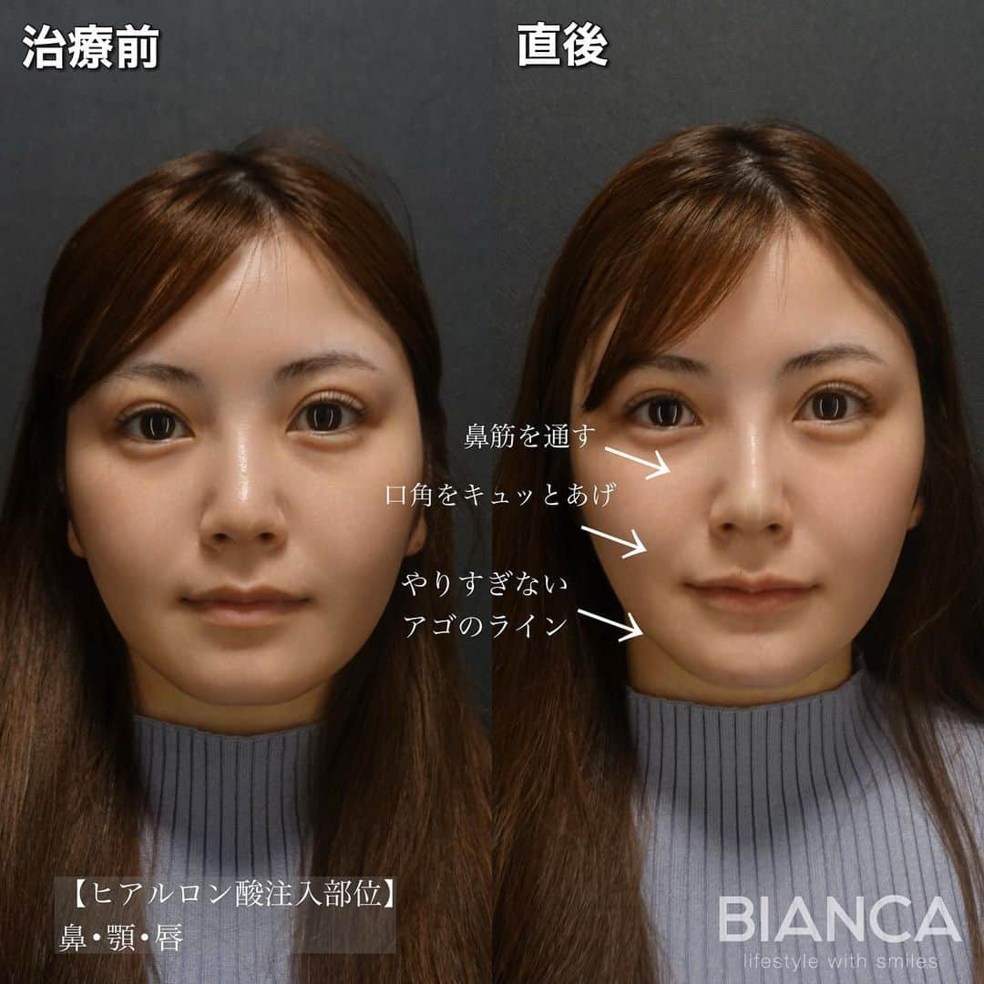 辻沢由有（BIANCA CLNIC 表参道院 院長）さんのインスタグラム写真 - (辻沢由有（BIANCA CLNIC 表参道院 院長）Instagram)「#dryuuヒアル　 【ヒアルロン酸でさらに美人へ✨】  治療時間、約10分👏 ヒアルロン酸でお顔を更に洗練🎉  どうなりたいかわからない方も こだわりがたくさんある方も 綺麗になりたい方、お任せください🥰  ✽.｡.:*・ﾟ ✽.｡.:*・ﾟ ✽.｡.:*・ﾟ ✽.｡.:*・ﾟ ✽.｡.:*・ﾟ  ✔︎鼻先〜鼻筋ヒアルロン酸 Juvederm VOLUX  1ml  107,800円＋税 ✔︎顎ヒアルロン酸 Juvederm VOLUX  1ml  77,000円＋税 ✔︎唇ヒアルロン酸 Juvederm VOLBELLA 1ml  77,000円＋税 別途施術料　22,000円＋税  ⏳治療時間: 10分 🗓持続期間: 1〜2年 😷腫れ・内出血: 数日程度 ⚠️リスク: 感染・血流障害・凹凸など  ✽.｡.:*・ﾟ ✽.｡.:*・ﾟ ✽.｡.:*・ﾟ ✽.｡.:*・ﾟ ✽.｡.:*・ﾟ  📝ご予約はwebが便利です✨ プロフィール欄のリンクからご予約ください。 ※医師指名可能（“大久保医師指名”をクリック） ※診察料はかかりません🙅‍♀️ ※表参道院勤務が9割となっています。  📍BIANCA CLINIC ※お電話頂くと自動音声通話に繋がります。 ✔︎表参道院 ☎️05018071593 東京都港区南青山5-11-10  南青山511ビル 2F ✔︎銀座院 ☎️05031964834 東京都中央区銀座1-8-19 キラリトギンザ12F  •診療時間 10:00〜19:00 •年中無休（年末年始を除く）   ✽.｡.:*・ﾟ ✽.｡.:*・ﾟ ✽.｡.:*・ﾟ ✽.｡.:*・ﾟ ✽.｡.:*・ﾟ  #鼻ヒアルロン酸 #鼻整形 #鼻先ヒアルロン酸 #唇ヒアルロン酸 #アゴヒアルロン酸 #eライン #横顔美人 #顎ヒアルロン酸 #貴族フィラー#リップヒアルロン酸#ヒアルロン酸」5月22日 16時12分 - i_am_yuu__