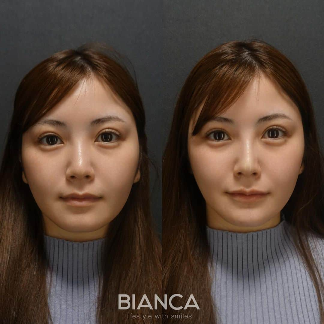 辻沢由有（BIANCA CLNIC 表参道院 院長）さんのインスタグラム写真 - (辻沢由有（BIANCA CLNIC 表参道院 院長）Instagram)「#dryuuヒアル　 【ヒアルロン酸でさらに美人へ✨】  治療時間、約10分👏 ヒアルロン酸でお顔を更に洗練🎉  どうなりたいかわからない方も こだわりがたくさんある方も 綺麗になりたい方、お任せください🥰  ✽.｡.:*・ﾟ ✽.｡.:*・ﾟ ✽.｡.:*・ﾟ ✽.｡.:*・ﾟ ✽.｡.:*・ﾟ  ✔︎鼻先〜鼻筋ヒアルロン酸 Juvederm VOLUX  1ml  107,800円＋税 ✔︎顎ヒアルロン酸 Juvederm VOLUX  1ml  77,000円＋税 ✔︎唇ヒアルロン酸 Juvederm VOLBELLA 1ml  77,000円＋税 別途施術料　22,000円＋税  ⏳治療時間: 10分 🗓持続期間: 1〜2年 😷腫れ・内出血: 数日程度 ⚠️リスク: 感染・血流障害・凹凸など  ✽.｡.:*・ﾟ ✽.｡.:*・ﾟ ✽.｡.:*・ﾟ ✽.｡.:*・ﾟ ✽.｡.:*・ﾟ  📝ご予約はwebが便利です✨ プロフィール欄のリンクからご予約ください。 ※医師指名可能（“大久保医師指名”をクリック） ※診察料はかかりません🙅‍♀️ ※表参道院勤務が9割となっています。  📍BIANCA CLINIC ※お電話頂くと自動音声通話に繋がります。 ✔︎表参道院 ☎️05018071593 東京都港区南青山5-11-10  南青山511ビル 2F ✔︎銀座院 ☎️05031964834 東京都中央区銀座1-8-19 キラリトギンザ12F  •診療時間 10:00〜19:00 •年中無休（年末年始を除く）   ✽.｡.:*・ﾟ ✽.｡.:*・ﾟ ✽.｡.:*・ﾟ ✽.｡.:*・ﾟ ✽.｡.:*・ﾟ  #鼻ヒアルロン酸 #鼻整形 #鼻先ヒアルロン酸 #唇ヒアルロン酸 #アゴヒアルロン酸 #eライン #横顔美人 #顎ヒアルロン酸 #貴族フィラー#リップヒアルロン酸#ヒアルロン酸」5月22日 16時12分 - i_am_yuu__