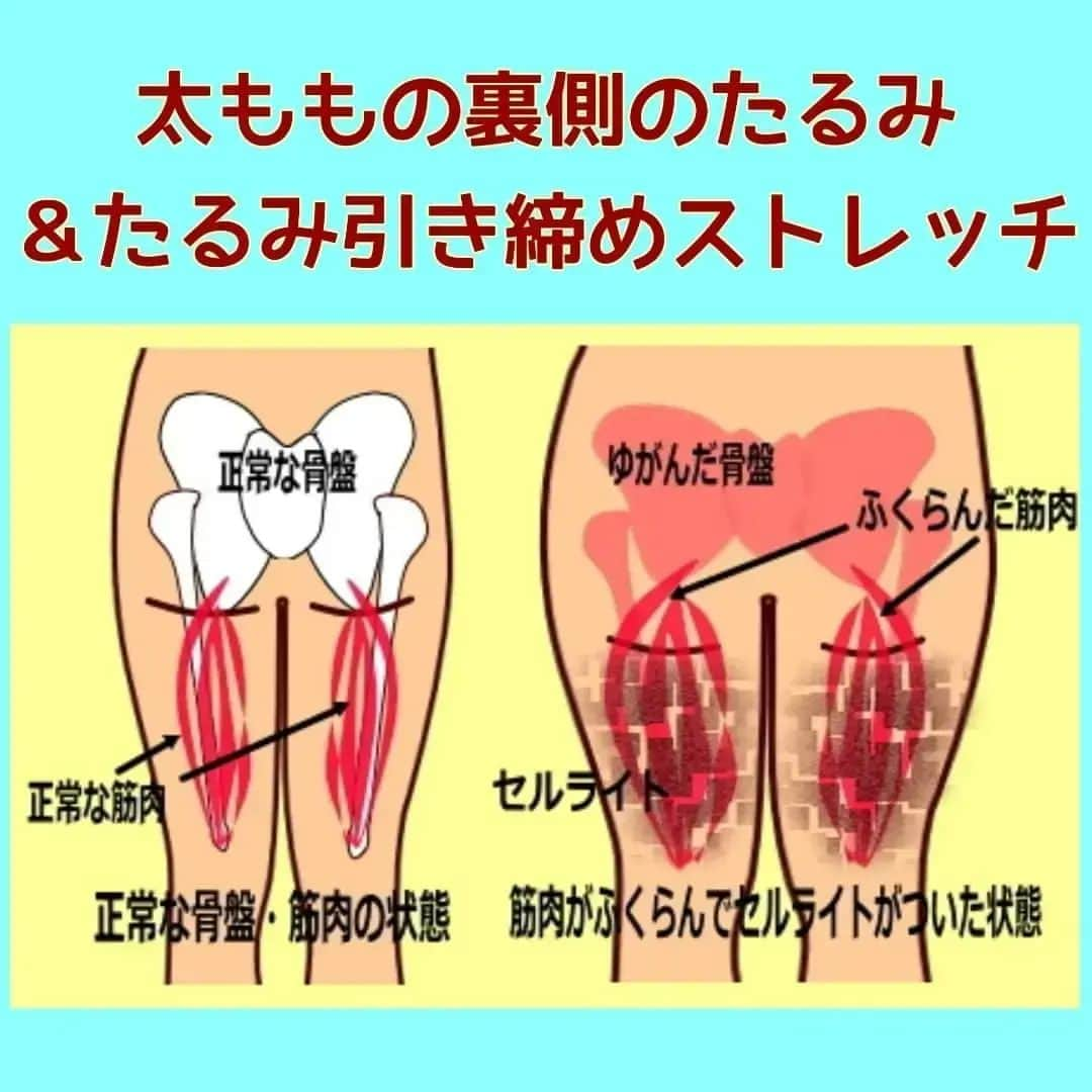 中目黒整体レメディオ 院長　渡邉潤一のインスタグラム：「太ももの裏がたるむのは、骨盤の歪みによって引き起こされる２つことに起因すると考えられます。  ①骨盤が歪んだことで股関節のずれが起こり、正しく脚が使えないこと。 ②骨盤が歪んだことで坐骨の位置がズレ、太ももの裏の筋肉にストレスがかかること。  まず①ですが、これは「骨盤が歪むと股関節も必ず歪む」という特徴に起因します。 これは、体のバランスを正常に保とうとするために、股関節の位置がずれ、ゆがんだ骨盤を支えようとするからです。  このとき、ずれた股関節の可動域は狭くなります。そのため歩くや走るなどの動作のときに、根本的に動きが制限されます。  ②の理由ですが、骨盤が歪むということはその骨盤の一部である坐骨の位置がずれてしまいます。 それにより、坐骨から膝の裏側まで伸びている筋肉（ハムストリング群）にストレスがかかり、筋肉が過度に緊張しているために本来の力を発揮できず、代謝量（熱量）が低下するからです。  この２つのことが合わさり、太ももの裏側の脂肪は燃焼されずむくみもとれず、たるんでしまうのです。 . . . ーーーーーーーーーーーーーーーーーーーーー  💮施術のご案内💮 中目黒整体レメディオ：骨盤・美脚コース 施術をご希望の方は、HPの予約フォームか、 お電話（0357735977）にてご連絡ください。  ーーーーーーーーーーーーーーーーーーーーー  #大転子 #大転子矯正 #o脚矯正 #x脚矯正 #膝下o脚 #XO脚 #骨格矯正 #骨盤矯正 #産後骨盤矯正 #下半身太り #下半身痩せ #太もも痩せ #ふくらはぎ痩せ #反り膝  #反り腰 #骨盤の歪み #整体 #レメディオ #姿勢矯正 #中目黒整体レメディオ #骨格診断 #ストレッチ」