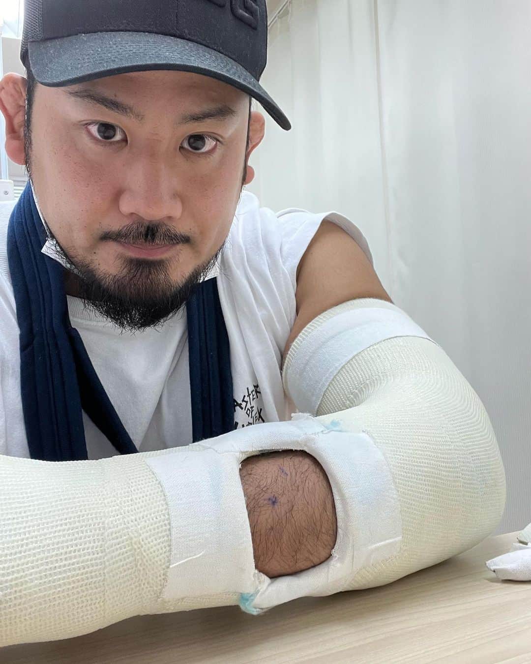 芦野祥太郎のインスタグラム：「左尺骨骨折から17日経過  超音波治療が出来るようにギプスに穴が空いてます  早く治れ腕 #ajpw #プロレス #骨折」