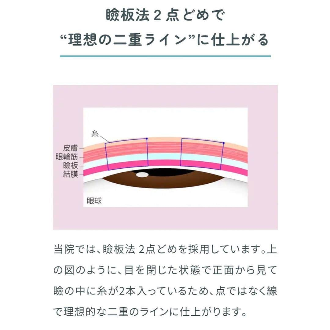 立花陽香さんのインスタグラム写真 - (立花陽香Instagram)「３年に一度の二重修正手術👁️というビッグイベントがありました💗💗💗 これで瞼の整形は４度目です。埋没法は４回までしかできないといわれていますが、修正の邪魔になるようなら抜糸をすればできます。（オプション💸） 私は瞼を切りたくないので、定期的な埋没法で粘ります👍 ストーリーにダウンタイムの経過を載せていたら、二重手術に関してのDM✉️が50件を超えたので、まだダウンタイム４日目ですがpost✍️します💕  肌治療でお世話になっている、お友達の幸ちゃん @ns.kaneshiro_mizunomori が勤める #水の森美容外科 @mizunomori_official 銀座院の竹村院長 @takemura_mizunomori に執刀して頂きました💓 カウンセリングは、5㍉〜の細かい世界。醜形恐怖症＆こだわりの強い私にも竹村院長は優しかったです。  ２日目までは目元全体に腫れありましたが、瞼は傷口の赤み程度で内出血は殆ど無く、腫れに左右差が無く、瞼のゴロゴロとした違和感が３日目で落ち着いて傷口が塞がって来たので、普段通りのメイクをしちゃいました✌️ もちろんダウンタイムには個人差がありますが、陽香史上では最速に感じています。 何度目でも「慣れ」なんてものはなく、整形は辛いものです。ダウンタイムはなるべく短い方が良い🥲 経験からいいますと、仕上がったかなー？っと感じるのは２週間ほど。 腫れは少しずつひいていきますが、術後１週間は瞼の傷と不自然な二重の食い込みと腫れはどうしても避けられない。そんな中でも内出血が無いと本当に気が楽です。  血行が良くなると腫れが長引くのですが、今日はお酒を少々飲んでしまいました。明日くらいからよもぎ蒸しも長風呂も出来るかなぁ🥺💕  水の森美容外科では以前、竹江総院長に涙袋と唇のヒアルを入れて頂いて、大満足の仕上がりでした。 美容クリニック難民の方、是非✨ご参考にしてください。  仕上がりが楽しみ〜💗💗💗  . #整形 #銀座 #水の森美容クリニック #二重 #二重修正 #二重整形 #二重整形経過 #平行型 #平行型二重 #二重埋没法 #埋没法 #埋没法経過 #埋没法ダウンタイム  #ダウンタイム」5月28日 5時55分 - haruka_4