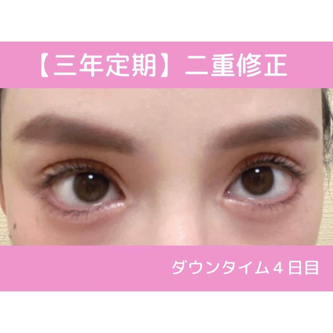 立花陽香さんのインスタグラム写真 - (立花陽香Instagram)「３年に一度の二重修正手術👁️というビッグイベントがありました💗💗💗 これで瞼の整形は４度目です。埋没法は４回までしかできないといわれていますが、修正の邪魔になるようなら抜糸をすればできます。（オプション💸） 私は瞼を切りたくないので、定期的な埋没法で粘ります👍 ストーリーにダウンタイムの経過を載せていたら、二重手術に関してのDM✉️が50件を超えたので、まだダウンタイム４日目ですがpost✍️します💕  肌治療でお世話になっている、お友達の幸ちゃん @ns.kaneshiro_mizunomori が勤める #水の森美容外科 @mizunomori_official 銀座院の竹村院長 @takemura_mizunomori に執刀して頂きました💓 カウンセリングは、5㍉〜の細かい世界。醜形恐怖症＆こだわりの強い私にも竹村院長は優しかったです。  ２日目までは目元全体に腫れありましたが、瞼は傷口の赤み程度で内出血は殆ど無く、腫れに左右差が無く、瞼のゴロゴロとした違和感が３日目で落ち着いて傷口が塞がって来たので、普段通りのメイクをしちゃいました✌️ もちろんダウンタイムには個人差がありますが、陽香史上では最速に感じています。 何度目でも「慣れ」なんてものはなく、整形は辛いものです。ダウンタイムはなるべく短い方が良い🥲 経験からいいますと、仕上がったかなー？っと感じるのは２週間ほど。 腫れは少しずつひいていきますが、術後１週間は瞼の傷と不自然な二重の食い込みと腫れはどうしても避けられない。そんな中でも内出血が無いと本当に気が楽です。  血行が良くなると腫れが長引くのですが、今日はお酒を少々飲んでしまいました。明日くらいからよもぎ蒸しも長風呂も出来るかなぁ🥺💕  水の森美容外科では以前、竹江総院長に涙袋と唇のヒアルを入れて頂いて、大満足の仕上がりでした。 美容クリニック難民の方、是非✨ご参考にしてください。  仕上がりが楽しみ〜💗💗💗  . #整形 #銀座 #水の森美容クリニック #二重 #二重修正 #二重整形 #二重整形経過 #平行型 #平行型二重 #二重埋没法 #埋没法 #埋没法経過 #埋没法ダウンタイム  #ダウンタイム」5月28日 5時55分 - haruka_4