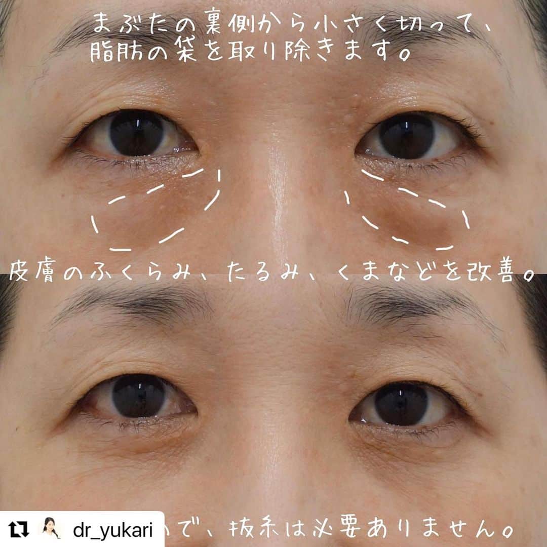 YAG BEAUTY CLINICさんのインスタグラム写真 - (YAG BEAUTY CLINICInstagram)「#Repost @dr_yukari with @use.repost ・・・ ✨下眼瞼脱脂✨  【写真📷】 上：術前 下：術後1ヶ月  【手術方法💉】 まぶたの裏側から小さく切って、脂肪の袋を取り除きます。皮膚のふくらみ、たるみ、くまなどを改善する治療。縫わないので、抜糸は必要ありません。  【リスク】 内出血や腫れのリスクがありますが、時間とともに引いていきます。  【値段💴】 300,000円+麻酔代  【モニター募集⚠️】 割引モニター募集してます。 お気軽にカウンセリングにお越し下さい✨」6月26日 11時02分 - yagbeauty_official