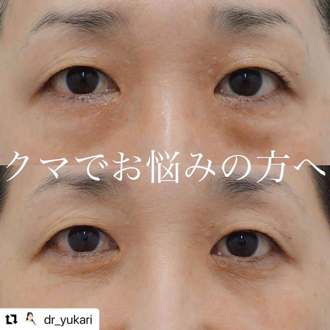 YAG BEAUTY CLINICさんのインスタグラム写真 - (YAG BEAUTY CLINICInstagram)「#Repost @dr_yukari with @use.repost ・・・ ✨下眼瞼脱脂✨  【写真📷】 上：術前 下：術後1ヶ月  【手術方法💉】 まぶたの裏側から小さく切って、脂肪の袋を取り除きます。皮膚のふくらみ、たるみ、くまなどを改善する治療。縫わないので、抜糸は必要ありません。  【リスク】 内出血や腫れのリスクがありますが、時間とともに引いていきます。  【値段💴】 300,000円+麻酔代  【モニター募集⚠️】 割引モニター募集してます。 お気軽にカウンセリングにお越し下さい✨」6月26日 11時02分 - yagbeauty_official