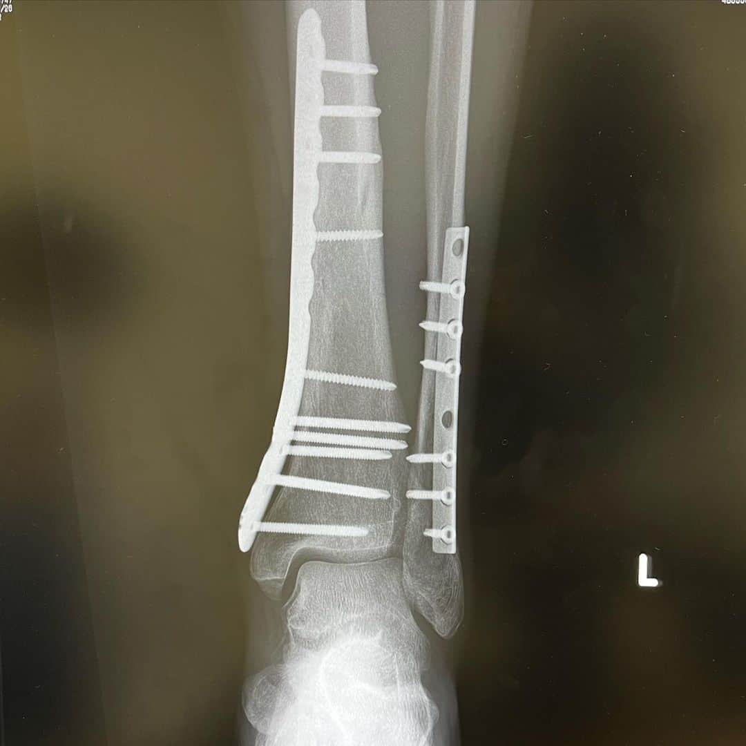 水谷あつしさんのインスタグラム写真 - (水谷あつしInstagram)「ご無沙汰しております。 まずはこの写真、病室からです。  左足を骨折(左脛骨腓骨遠位端骨折)してから1年が経ちました。 おかげさまで骨も完全にくっつきました。 レントゲン写真をお見せしましょう。 いきなりの衝撃映像！すみません。  こんな感じに2本の骨を固定されていたんです。  そしてついにプレートを抜く手術をしました。  左足抜釘手術。  手術前日から入院し、術後も病室で安静にして経過も良好と言う事で本日退院。  術後記念にといただきました。 固定していた2枚のプレートと17本のネジ。 こんなにカラフルなのが入ってたの？  まだ傷口が痛みますが、経過は良好の様です。 しばらく安静に過ごします。  稽古には足も万全になる予定です。  そうです！劇場から劇場を走るのです！  次回出演作はこちら↓  2023年　紀伊國屋ホール／シアタートップス　2劇場キャスト往復同時上演！ 『ダブルブッキング！』-2023- 開演まであと2時間！  2023年7月13日(木)～7月23 日(日)  新宿シアタートップス／紀伊國屋ホール　※2劇場同時上演  【本番日時】 7月13日(木)19:00 7月14日(金)19:00 7月15日(土)13:00・18:00 7月16日(日)13:00・18:00 7月17日(月･祝)13:00・18:00 7月18日(火)休演日 7月19日(水)19:00 7月20日(木)19:00 7月21日(金)14:00・19:00 7月22日(土)13:00・18:00 7月23日(日)13:00 ※11日間15公演  【料金】 シアタートップス　8,000円　／　紀伊國屋ホール　S席7,000円　Ａ席5,500円  【一般販売】 販売期間：6/17(土)12:00～ https://confetti-web.com/db_2023  【キャスト】 野澤祐樹 ／ 佐伯亮　芹沢尚哉　堀田怜央　菊池泰生 ／ 里内伽奈　関根優那　糸原舞　高橋紗良 ／ チャン・ユジュン 渡部将之　竹尾一馬 ／ 水谷あつし ／ 山岡三四郎　海老澤英紀　小林祐真　小林和也 ／ 竹本かすみ　堀江あや子　磯崎美穂　美波花音 ／ 久保田秀敏  ※中山義紘 さんのご出演が決定致しました。  【スタッフ】 作・演出：堤泰之　音楽：楠瀬拓哉　美術：本江義治　照明：阿部典夫　音響：山本浩一　舞台監督：坂野早織　演出助手：稲葉佳那子　ヘアメイク：吉森香織　宣伝美術：田中しおり　カメラマン：園田昭彦　宣伝：雲林院康行/佐藤知子/山内早紀　宣伝協力・票券：吉田祥二/北村隆行　制作協力：北川仁志　制作：志岐光璃　プロデューサー：難波利幸　  【公式HP】 https://no-4.biz/doublebooking  【企画・製作】 株式会社エヌオーフォー【NO.4】」6月3日 23時11分 - achao726