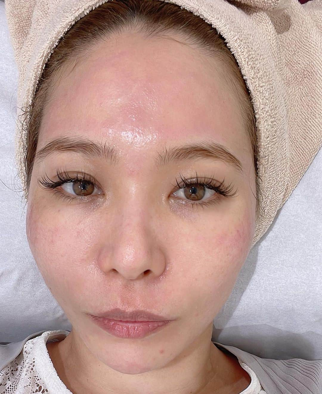 エリカ・セイラさんのインスタグラム写真 - (エリカ・セイラInstagram)「@ic.clinic.beauty でヴェルヴェットスキンを受けてきたよ🩵 ヴェルヴェットスキンは、ダーマペンとマッサージピールを組合わせた施術なんだけど、針で皮膚に小さな穴をあけた後、美容薬剤を浸透させてコラーゲンの産生を促す効果があるみたい🩵  ニキビ跡やクレーターの改善 開いた毛穴の改善 肌のくすみやしわの改善  に効果的だから、全部気になる私は前からやってみたかったんだよね！  まずは麻酔クリームを顔全体に塗ってから始めるから、痛みは全然感じなかったよ！  直後は顔全体に赤みが出たから、帽子とマスクをつけてすぐ帰宅！  夜には赤みが引いて、次の日には赤みはすっかり消えてた👍🏻  少し皮むけしたけど、3日後には肌ピカピカッ🩵  1番最後の写真が3日後に撮った すっぴんの写真だよ🩵  肌のざらつきがなくなってツルツルに、ハリがある感じで、これはすごい🩵  施術の次の日にはメイクもできちゃうから、忙しい人にも大丈夫🩵 これはみんなにオススメしたい🩵  https://ic-clinic.com/treatment/velvet-skin/  #PR #インフルエンサーワークス #アイシークリニック #美肌治療 #スキンケア #美肌 #肌質改善 #コラーゲン #ヴェルヴェットスキン #ダーマペン #美容好きと繋がりたい    #インフルエンサー #モデル #ダイエット #トレーニング女子 #tokyo #ホテルディナー #チャイナブルー #コンラッド東京 #コンラッド #conradtokyo #汐留グルメ #東京グルメ #港区グルメ #スキンケア #美容 #conrad #ホテルステイ #ホカンス #港区ディナー #東京ホテル」6月5日 14時07分 - erica_sarah_