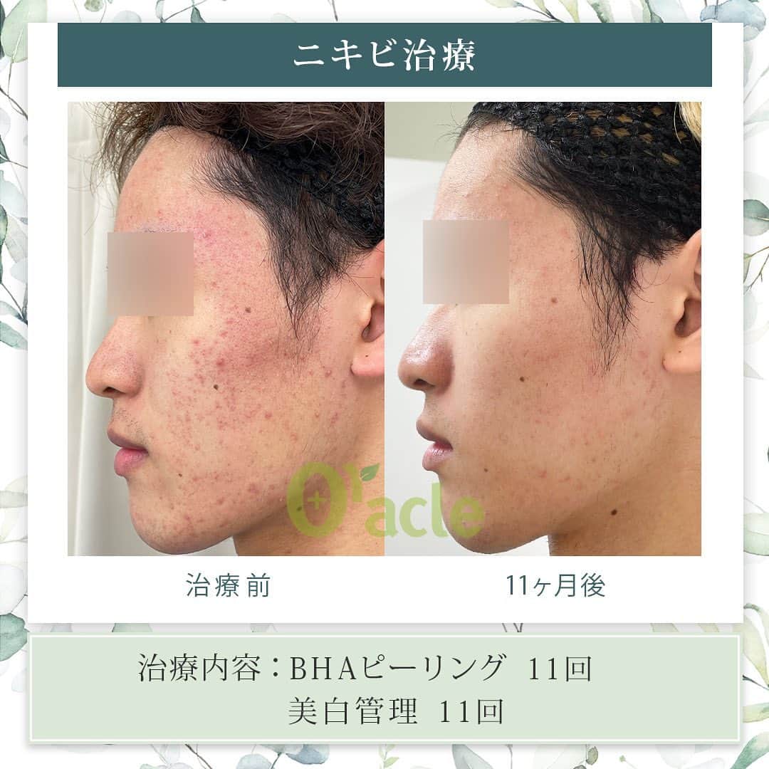 オラクル美容皮膚科東京新宿院のインスタグラム：「◤ニキビ治療症例◢| 《治療内容》 BHAピーリング11回 美白管理11回 →赤い炎症ニキビ、詰まったぷつぷつした白ニキビの改善  ☑️BHAピーリング 高濃度サリチル酸ピーリングです。お肌の表面を殺菌し、繰り返し行うことでニキビはできづらいお肌に改善  【ダウンタイム】▶︎ほぼありません 赤み：数時間 皮剥け:1週間 洗顔、メイクは当日から◎ ⁡ 【料金】 1回　11,000円 ▶︎面ぽう圧出、ゴムパックつき ⁡ ☑️美白管理 ニキビのお肌は乾燥している方が多く、その乾燥がニキビの原因になっているいることも。 美白管理では、お肌の状態に合わせてビタミンＣ、もしくはトラネキサム酸をお肌に導入していきます。 ⁡ 【料金】 1回　11,000円(税込)  ※トラネキサム酸orビタミンC ☞肌状態でお選びいたします。 ⁡ #ピーリング  #ニキビ治療 #ニキビ肌 #赤ら顔 #ニキビ跡 #ニキビケア　 #韓国美容 #皮膚科　#美容皮膚科 #ニキビ　#ニキビ改善」