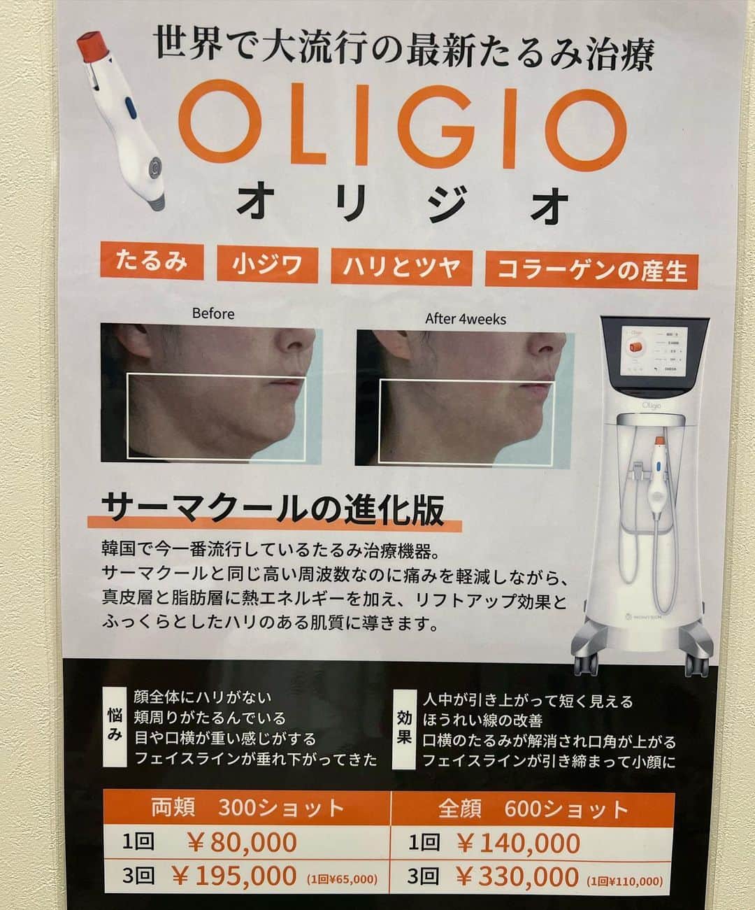 ImotoEtsuyo さんのインスタグラム写真 - (ImotoEtsuyo Instagram)「・  ・ フェイスラインが 引き締まってる💕💕  施術後1週間の写真 ・　 ・  たるみやシワのみならず、 肌質を改善！ そして肌にハリもたらし ふっくらとした 仕上がりになると話題の 『OLIGIO 』オリジオ！  ・ 新宿の #カンナム美容外科  @dr_akiyoshi_yamamoto  で　#オリジオ を 受けたのです！ ・  韓国で今一番流行している たるみ治療機器だそう！  引き締めやシワ改善だけでなく、 パンとしたハリが出ることも 実証されているそうで、 皮膚を再生する力も 引き出してくれるそう。  効果は  ✴︎シワたるみの改善 ✴︎小顔効果 ✴︎肌質改善 ✴︎アンチエイジ ✴︎毛穴の引き締め  人中が引き上がって短く見えたり ほうれい線も改善‼️  気になっていた口横のたるみも 上がりフェイスラインが 引き締まりました🤍　  効果は何と半年位持続するみたい。 これは良い！  また半年後受けに行きたい‼️  ・ 同時に#エレクトロポレーション も 受けたので、また別投稿しますね！ ・ ・ 〒160-0023  東京都新宿区西新宿7-10-18　 小滝橋パシフィカビル６階  03-6279-1502  動画もご覧下さいね。  ーーーーーーーーーーーーーーーーーーー ◾️カンナム美容外科　新宿院 山本院長先生 @dr_akiyoshi_yamamoto   ポテンツァ・オリジオ・ エクソソーム点滴など人気がある 施術も良心的な価格。  ーーーーーーーーーーーーーーーーーーー #カンナム美容外科  #美容 #新宿美容  #オリジオ #oligio #美  #美肌  #beauty  #シワ #シミ  #たるみ #美白  #美白ケア #小顔 #アラフィフ  #アラフィフ美容 @gangnam._.official」6月5日 18時03分 - bisuhada