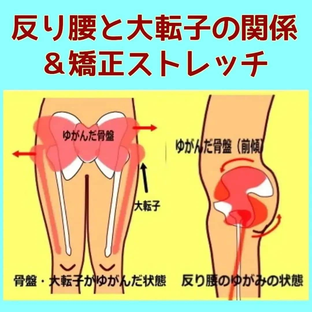 中目黒整体レメディオ 院長　渡邉潤一のインスタグラム：「下半身太りの方は、反り腰の癖と大転子のゆがみがある方が非常に多いです。  ここでは、この反り腰と大転子の関係性についてはお話ししていきます。  反り腰と大転子の出っ張りは密接に関係しており、この２つに共通しているゆがみは股関節の内側へのねじれです。  反り腰の状態の時、骨盤は前傾します。 骨盤が前傾したことで、股関節の位置は後ろに下がります。 後ろに下がったことで股関節を支点に太ももの骨は後ろに下がりながら内側に捻れます。 この時に大転子が外側に出っ張っります。  また、股関節が内側に捻れるときには、股関節の前側の筋肉が収縮し固まります。 これにより、元に戻ろうとする太ももの外側への捻じれが阻害に、うまく大転子が引っ込んでくれません。  同様に、反り腰を解消するために骨盤を立てようとしても、股関節の前側が固まっているので、うまく骨盤を立たせることもできません。  反り腰や大転子の出っ張りを解消する体操やトレーニングをしてもなかなか効果が出ない方は、股関節に捻じれや詰まりなどのゆがみが起こっているからです。  まずは股関節のねじれ解消してから、体操やトレーニングをしてください。 これまでより効果が出やすくなると思いますよ。 . . . ーーーーーーーーーーーーーーーーーーーーー  💮施術のご案内💮 中目黒整体レメディオ：骨盤・美脚コース 施術をご希望の方は、HPの予約フォームか、 お電話（0357735977）にてご連絡ください。  ーーーーーーーーーーーーーーーーーーーーー  #大転子 #大転子矯正 #o脚矯正 #x脚矯正 #膝下o脚 #XO脚 #骨格矯正 #骨盤矯正 #産後骨盤矯正 #下半身太り #下半身痩せ #太もも痩せ #ふくらはぎ痩せ #反り膝  #反り腰 #骨盤の歪み #整体 #レメディオ #姿勢矯正 #中目黒整体レメディオ #整体サロン #大転子ストレッチ #骨格診断」