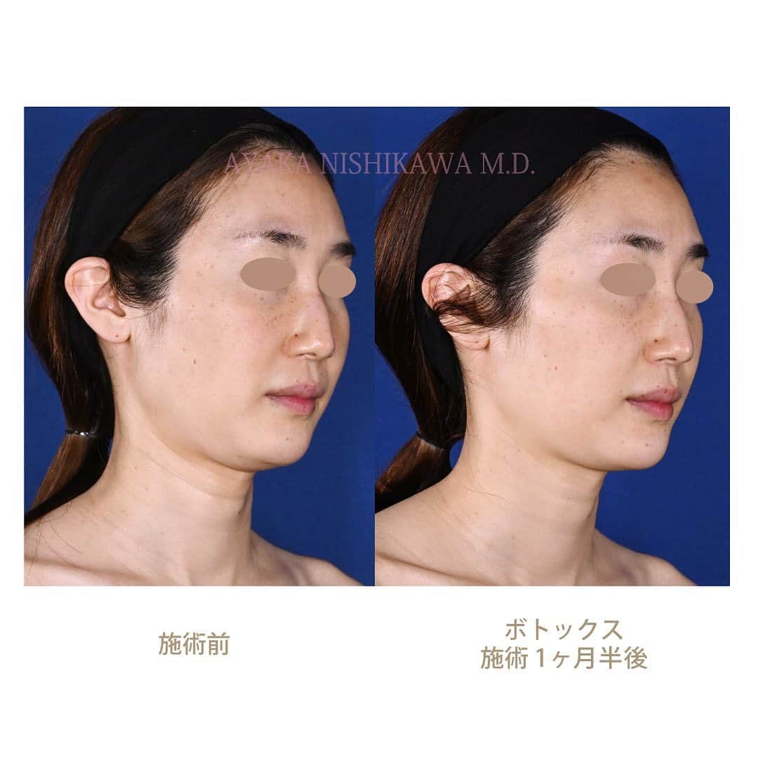 西川礼華のインスタグラム：「「エラボトックスしたらタルミが悪化する？」この質問をよく受けます。はい、たしかに、一気にエラボトックスが効いて咬筋が萎縮することで、皮膚及び皮下組織が弛むことはあります。特にこちらのお客様のように、元々頬がやや痩せているタイプの方は、エラボトックス後に頬のコケ（凹み）が強調されフェイスラインが不整になることもあります。…しかし、工夫をすることで、エラボトックスによる小顔治療を安全に受けていただくことも可能と考えています。 こちらの症例は、先日の美容外科学会JSASで発表したもののひとつです。元々頬骨下の凹みがあり面長なタイプの顔出ち。エラ（咬筋）にボトックスを注入する際に、工夫が必要となります。咬筋へのボトックス注入量や投与範囲のデザインを慎重に行います。また、咬筋だけでなく、顎（頤筋）と頸部（広頚筋）へのボトックス注入を併用することで、小顔効果を出しながらもフェイスラインをリフトさせる効果も出しました。ボトックスリフトと言われるテクニックでもあります。ご覧の通り、術後、お顔がスッキリしています。糸リフトまでしなくても、注入治療だけでも工夫すれば十分対処できることが多いです😊  また、実は首の横ジワもよくなってると思いませんか？このタイプのお客様は、頸部ボトックスの注入方法を工夫すると、首の横ジワも改善することもありますね。このあたり、美容皮膚科医の腕の見せどころです。 単に注射すれば良いというものではありません。こだわって治療を提供させていただいています。  施術名：ボトックス 施術の説明：神経からアセチルコリンが出るのを抑え、筋肉の過剰な動きをやわらげます。 施術の副作用：疼痛・腫れ・内出血・アレルギー・表情に違和感を生じる可能性があります。 施術の価格：エラ、顎、頸部 全てで84,550円（税込）  #エラボトックス #ボトックスリフト　　 #頸部ボトックス #小顔治療 #ayakanishikawa #西川礼華 #湘南美容クリニック」