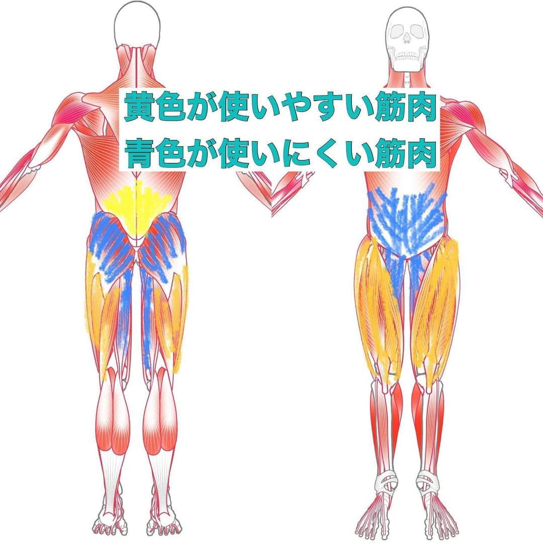 森 拓郎のインスタグラム：「下腹ぽっこり、前もも張る、反り腰などは連動している。 、 黄色の前ももや外もも、裏ももの外側、腰などは使われやすくて硬くなったり太くなったりしている。 、 青色の部分のお尻や裏ももの内側、内もも、下腹やその奥の腸腰筋などは、黄色に邪魔されて使いにくい。 、 腹筋のトレーニングやお尻のトレーニングは大事だけど、黄色の部分を使う癖が強いと、腹筋を鍛えているのに腰が辛い、前ももが辛いなどが起きがち。 お尻のトレーニングでもそう。 、 まずは、使いすぎてしまう筋肉をほぐしたり、ストレッチをしてからの方が、お尻もお腹も機能しやすくなりますよ。 #森拓郎　#ボディメイク #ダイエット　#下腹ぽっこり #脚やせ」