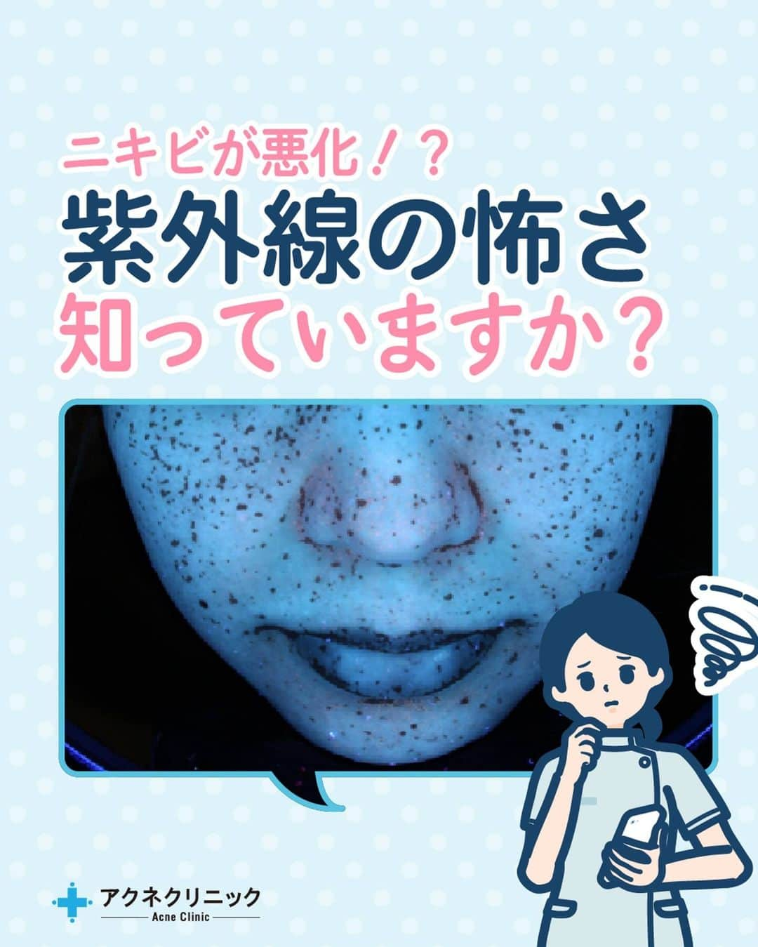 東京アクネクリニックのインスタグラム：「皆さんは紫外線の影響を知っていますか？ 実は日焼けだけではなく、ニキビや老化の原因にもなるんです。   今回は、ニキビと紫外線の関係について詳しく解説していきます。  紫外線対策を始めようと思った人は「✨」で教えてくださいね！ ∴‥∵‥∴‥∵‥∴‥∴‥∵‥∴‥∵‥∴  アクネクリニック｜ニキビ・ニキビケア  @nikibi.c  他の投稿もぜひチェックしてみてくださいね🥰  ∴‥∵‥∴‥∵‥∴‥∴‥∵‥∴‥∵‥∴ #ニキビ#ニキビ跡#大人ニキビ#ニキビ対策#ニキビ治療#大人ニキビ対策#ニキビの原因#ニキビ治したい#アクネクリニック#アクネニキビ対策#イソトレチノイン#ダーマペン4#フラクセル#日焼け止め#紫外線#光老化#ドクターズコスメ#紫外線対策#紫外線ケア#日焼け止め必須」