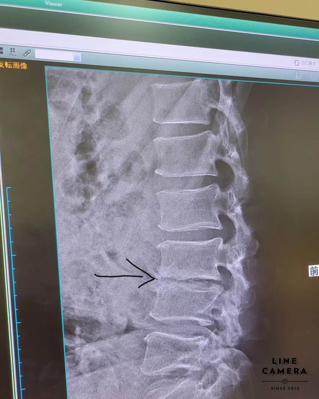 高岩竜一のインスタグラム：「『脊柱管狭窄症』 私の腰のレントゲン写真💀 矢印の部分の隙間がありません😓 これによって神経を圧迫しているみたいです😖💥 ブロック注射💉をしながら、頑張って治療を続けよう😅」