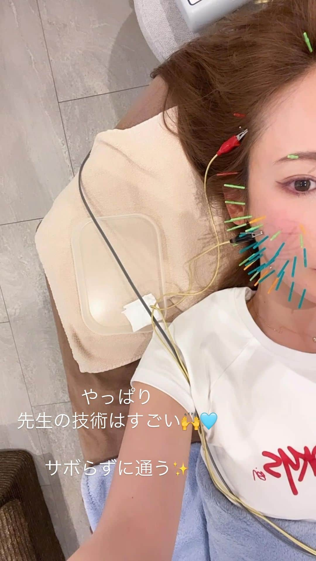 千波のインスタグラム：「もう10年近くお世話になってます✨ いろんな小顔とか頭蓋骨矯正いったけど 角森小顔先生の技術はすごくて 本当にオススメです🫶  しばらく小顔矯正してもらってなかったから 顔歪んでたけど やってもらうと全然違う😳 顔長いのと歪み、平面的な顔が すごく悩みなのですが 施術後は 手で顔を覆うとすっぽり入る感じ、 立体的に見えます✨ 持って生まれたパーツって変えれないけど😂 紗栄子ちゃんには程遠いけど。笑 施術してもらうことで 昨日までよりは良くはなる！！♡ また、まじめに通い始めました🫶 継続もメンテもほんとに大事！  そして節目節目でエネルギーを くれた人😎🤟 本当にパワフル〜🌏 何気ない会話で 後押しされたり、決めた事が何度かあって。 人生が変わるきっかけとなった人が 何人かいるけど @kadomori570731 角森先生と @saori_kadomori_osaka 沙織さんは そのうちの２人🌏 いつもありがとうございます🩵  happy birthdayありがとう🤣  #小顔矯正 #小顔先生  #美容鍼  #エイジングケア」