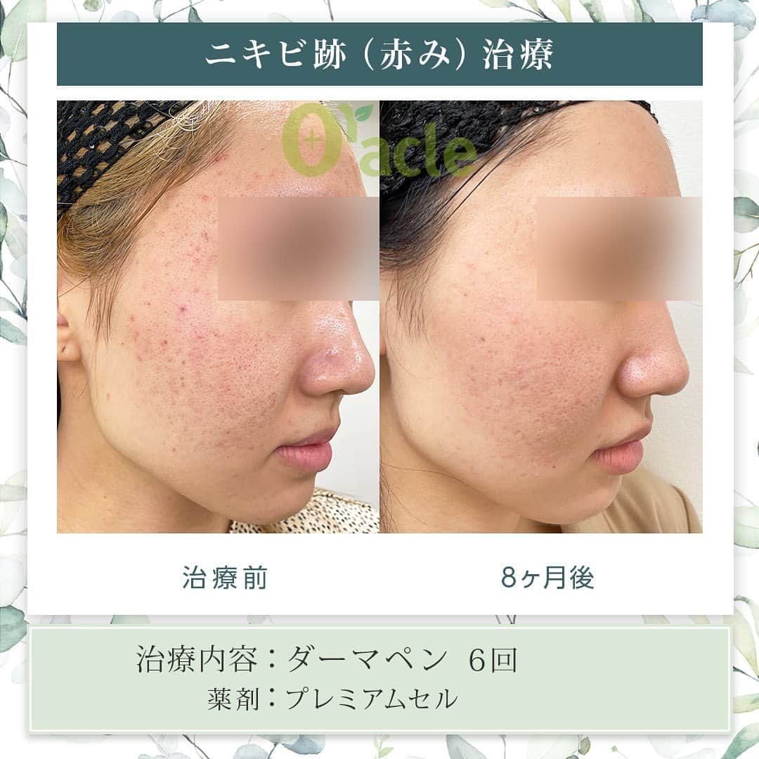 オラクル美容皮膚科東京新宿院のインスタグラム：「◤ニキビ跡治療症例◢| 《治療内容》 ①ダーマペン　 ※薬剤：プレミアムセル 各6回 プレミアムセルの導入で赤みが軽減されています。毛穴に対しては、引き続きダーマペンや熱を加える高周波などで継続されるのがおすすめです。  ☑️ダーマペン 微細な針で皮膚に穴をあけ、ダメージを与えます。 そのダメージを修復しようとする自己修復機能によりお肌を再生させます。  【ダウンタイム】 赤み：2〜7日 浮腫み：出る方もいる 皮剥け：5〜6日 洗顔、メイクは翌日以降  【料金】※税込み ▶︎ダーマペン1回19,800円 ▶︎薬剤　プレミアムセル4,500円 麻酔代2,200円 ⁡ #ニキビ跡 #ニキビ跡治療 #ダーマペン #毛穴 #毛穴ケア #ニキビ跡ケア #毛穴引き締め #赤ら顔　#赤ら顔治療」