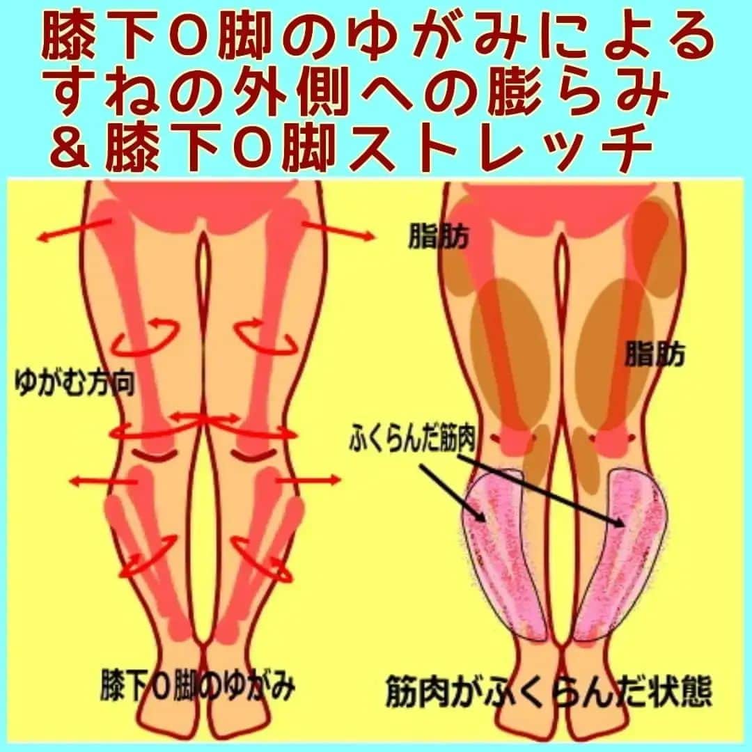 中目黒整体レメディオ 院長　渡邉潤一のインスタグラム：「すねの部分が外側に膨らんでいると、膝下が曲がって見えます。 これは、膝下の関節のゆがみにより、すねの筋肉（前脛骨筋）が硬くなっているからです。  膝下がゆがんでいる場合、すねの骨（脛骨）が外側に歪んでいます。 これは重心が外側にきていることで起こり、そのバランスを保とうとする事が原因です。 他にも骨盤の広がりや、太もものねじれなどを支えるためだとも考えられます。  筋肉が収縮するときの特徴として、硬くなると膨らむという性質があります。 たとえば、力こぶを作ると上にもりあがるような事です。  すねの骨のゆがみにより、すねの横の筋肉（ピンク部分）が緊張し上下に収縮します。 それにより前に膨らむような形状になります。  この状態が常に起きていると、筋肉は膨らんだままになります。 また、その部分の神経もそれが正常であると誤解し、その状態を維持してしまいます。  これが、すねの筋肉が硬くなったことにより、正面から見るとすねの骨が曲がっているように見せているのです。 . . ーーーーーーーーーーーーーーーーーーーーー  💮施術のご案内💮 中目黒整体レメディオ：骨盤・美脚コース 施術をご希望の方は、はHPの予約フォームか、 お電話（0357735977）にてご連絡ください。  ーーーーーーーーーーーーーーーーーーーーー  #大転子 #大転子矯正 #o脚 #x脚 #膝下o脚 #XO脚 #骨格矯正 #骨盤 #産後の骨盤 #下半身太り #ダイエット #太もも #ふくらはぎ #反り膝  #反り腰 #骨盤の歪み #整体 #レメディオ #姿勢矯正 #中目黒整体レメディオ #骨格診断 #内巻き膝 #脚痩せ」