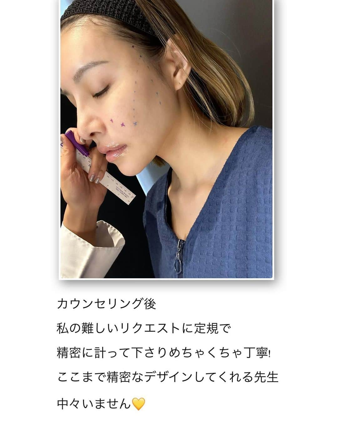 難波サキさんのインスタグラム写真 - (難波サキInstagram)「-𝐁𝐞𝐚𝐮𝐭𝐲🧚🏻‍♀️  37歳になる前にアンチエイジング作戦🙋🏼‍♀️ 糸リフト🪡したよ❗️ スライドで説明付きで詳細書いてます✨  凄腕ドクター🧑‍⚕️で有名な(友達情報) @dr_guccy 先生にお願いしました🤍  今回はここ半年で体重が急増加したので 頬にお肉がついてしまってがっつりほうれい線… 横顔は弛み…を気にしてまして… 友達に有名な先生いるよって教えてもらい 速攻で予約して行きました🤣  院内はめちゃくちゃラグジュアリーで どこのホテルですか？並。  スタッフさんもご丁寧すぎて親切。 カウンセリングが始まり先生もとても親身。 カウンセリングは本当に重要だからね❗️ みんなそれぞれ骨格が違うから自分の理想を しっかり細かく伝えるのが大事👌🏼 骨格から計算して精密に定規でデザイン してくれる先生は初めてでビックリ&安心✨  痛み止め点滴って知ってる⁉️ 初めて知って中々無いそうで… 初めて静脈麻酔無しで施術しましたが なんと…痛みに弱い私…大丈夫でした😆🙌🏽 術後も痛みほぼなく腫れもほぼ無く🙌🏽 スライド📸見てみてね✨  ↓ここからは前回も書いた内容と近いです↓ 糸リフト🪡って沢山種類があるので クリニックによって違うし、弛み方でも 違うので、カウンセリングを大事に❣️ がすごくポイントです❣  ※ダウンタイムはどれくらい？ →必ず個人差があります。 クリニックさんで先生に聞いてみてね❣️  気になる方はクリニックに🏥 問い合わせしてまずはカウンセリングへ✨ 👉🏻 @casa.de.gracia_ginza   #アンチエイジング #糸リフト#アラフォー美容は継続が命 #リフトアップ#ほうれい線対策#アラフォー美容」6月14日 20時30分 - sakinanba