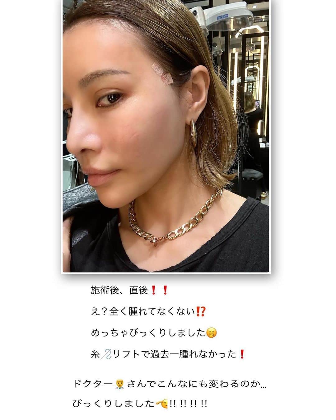 難波サキさんのインスタグラム写真 - (難波サキInstagram)「-𝐁𝐞𝐚𝐮𝐭𝐲🧚🏻‍♀️  37歳になる前にアンチエイジング作戦🙋🏼‍♀️ 糸リフト🪡したよ❗️ スライドで説明付きで詳細書いてます✨  凄腕ドクター🧑‍⚕️で有名な(友達情報) @dr_guccy 先生にお願いしました🤍  今回はここ半年で体重が急増加したので 頬にお肉がついてしまってがっつりほうれい線… 横顔は弛み…を気にしてまして… 友達に有名な先生いるよって教えてもらい 速攻で予約して行きました🤣  院内はめちゃくちゃラグジュアリーで どこのホテルですか？並。  スタッフさんもご丁寧すぎて親切。 カウンセリングが始まり先生もとても親身。 カウンセリングは本当に重要だからね❗️ みんなそれぞれ骨格が違うから自分の理想を しっかり細かく伝えるのが大事👌🏼 骨格から計算して精密に定規でデザイン してくれる先生は初めてでビックリ&安心✨  痛み止め点滴って知ってる⁉️ 初めて知って中々無いそうで… 初めて静脈麻酔無しで施術しましたが なんと…痛みに弱い私…大丈夫でした😆🙌🏽 術後も痛みほぼなく腫れもほぼ無く🙌🏽 スライド📸見てみてね✨  ↓ここからは前回も書いた内容と近いです↓ 糸リフト🪡って沢山種類があるので クリニックによって違うし、弛み方でも 違うので、カウンセリングを大事に❣️ がすごくポイントです❣  ※ダウンタイムはどれくらい？ →必ず個人差があります。 クリニックさんで先生に聞いてみてね❣️  気になる方はクリニックに🏥 問い合わせしてまずはカウンセリングへ✨ 👉🏻 @casa.de.gracia_ginza   #アンチエイジング #糸リフト#アラフォー美容は継続が命 #リフトアップ#ほうれい線対策#アラフォー美容」6月14日 20時30分 - sakinanba