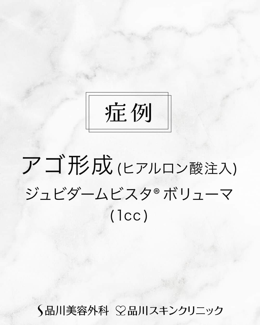 品川美容外科【公式】のインスタグラム：「施術直後のお写真です✨ アゴの形を整えて、横顔を綺麗に❣️ 　　 💎施術名 アゴ修整／ヒアルロン酸注入(ジュビダームビスタ®ボリューマ) 　　　 💎執刀医 品川美容外科 銀座院  院長 菅原 章隆（ @dr.sugahara  ） 　　　 ┈┈┈┈┈┈┈┈┈┈┈┈┈┈┈┈　 　　 ヒアルロン酸注入でアゴのラインを整える治療 【価格】1cc 69,800円(税込) 【副作用・リスク】腫れ：2～3日位｡内出血:1～2日位｡ 【TEL】0120-095-200 　　 ┈┈┈┈┈┈┈┈┈┈┈┈┈┈┈┈　　　   カウンセリングは無料です❣️是非ご相談ください✨   💎お問い合わせ 品川美容外科：0120-189-900 品川スキンクリニック：0120-575-900 プロフィール画面のURLからWEB予約が可能です💁 ▶@shinagawa.biyou   ※公的保険適用外となります。 ※掲載の全部または一部の治療は薬機法未承認の医療機器・医薬品を使用しています。医師の責任の下、個人輸入により治療を行っております。※個人輸入された医薬品等の使用によるリスク情報 https://www.yakubutsu.mhlw.go.jp/individualimport/   #品川美容外科 #品川スキンクリニック #美容 #美容医療 #美容皮膚科 #あご出し #ヒアルロン酸 #プチ」