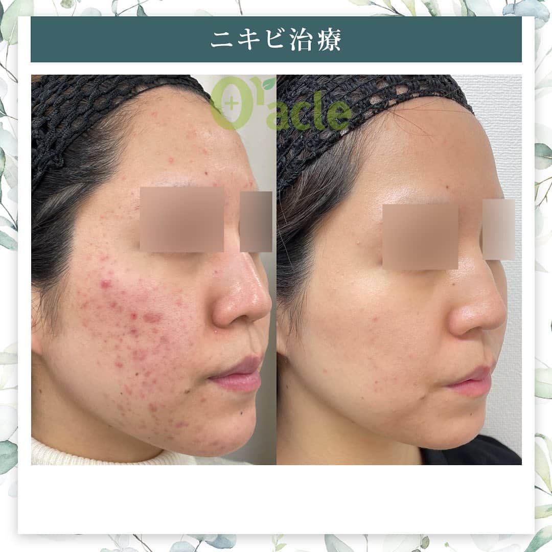 オラクル美容皮膚科東京新宿院さんのインスタグラム写真 - (オラクル美容皮膚科東京新宿院Instagram)「|◤ニキビ治療症例◢|  《治療内容》 BHAピーリング8回 美白管理8回 →治療を始めてから1年後の経過です 別人級のお肌に👏👏  ☑️BHAピーリング 高濃度サリチル酸ピーリングです。お肌の表面を殺菌し、繰り返し行うことでニキビはできづらいお肌に改善  【ダウンタイム】▶︎ほぼありません 赤み：数時間 皮剥け:1週間 洗顔、メイクは当日から◎ ⁡ 【料金】 1回　11,000円 ▶︎面ぽう圧出、ゴムパックつき ⁡ ☑️美白管理 ニキビのお肌は乾燥している方が多く、その乾燥がニキビの原因になっているいることも。 美白管理では、お肌の状態に合わせてビタミンＣ、もしくはトラネキサム酸をお肌に導入していきます。 ⁡ 【料金】 1回　11,000円(税込)  ※トラネキサム酸orビタミンC ☞肌状態でお選びいたします。 ⁡ #ピーリング  #ニキビ治療 #ニキビ肌 #ニキビ跡 #ニキビケア　#新生活準備  #韓国美容 #皮膚科　#美容皮膚科 #ニキビ　#ニキビ改善」6月16日 18時04分 - oraclejp