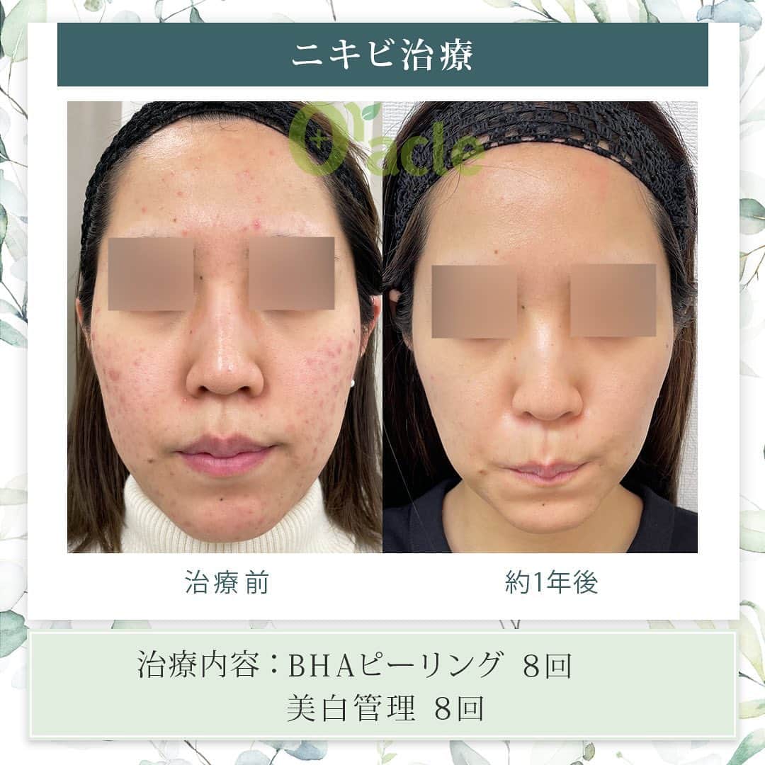 オラクル美容皮膚科東京新宿院のインスタグラム：「|◤ニキビ治療症例◢|  《治療内容》 BHAピーリング8回 美白管理8回 →治療を始めてから1年後の経過です 別人級のお肌に👏👏  ☑️BHAピーリング 高濃度サリチル酸ピーリングです。お肌の表面を殺菌し、繰り返し行うことでニキビはできづらいお肌に改善  【ダウンタイム】▶︎ほぼありません 赤み：数時間 皮剥け:1週間 洗顔、メイクは当日から◎ ⁡ 【料金】 1回　11,000円 ▶︎面ぽう圧出、ゴムパックつき ⁡ ☑️美白管理 ニキビのお肌は乾燥している方が多く、その乾燥がニキビの原因になっているいることも。 美白管理では、お肌の状態に合わせてビタミンＣ、もしくはトラネキサム酸をお肌に導入していきます。 ⁡ 【料金】 1回　11,000円(税込)  ※トラネキサム酸orビタミンC ☞肌状態でお選びいたします。 ⁡ #ピーリング  #ニキビ治療 #ニキビ肌 #ニキビ跡 #ニキビケア　#新生活準備  #韓国美容 #皮膚科　#美容皮膚科 #ニキビ　#ニキビ改善」