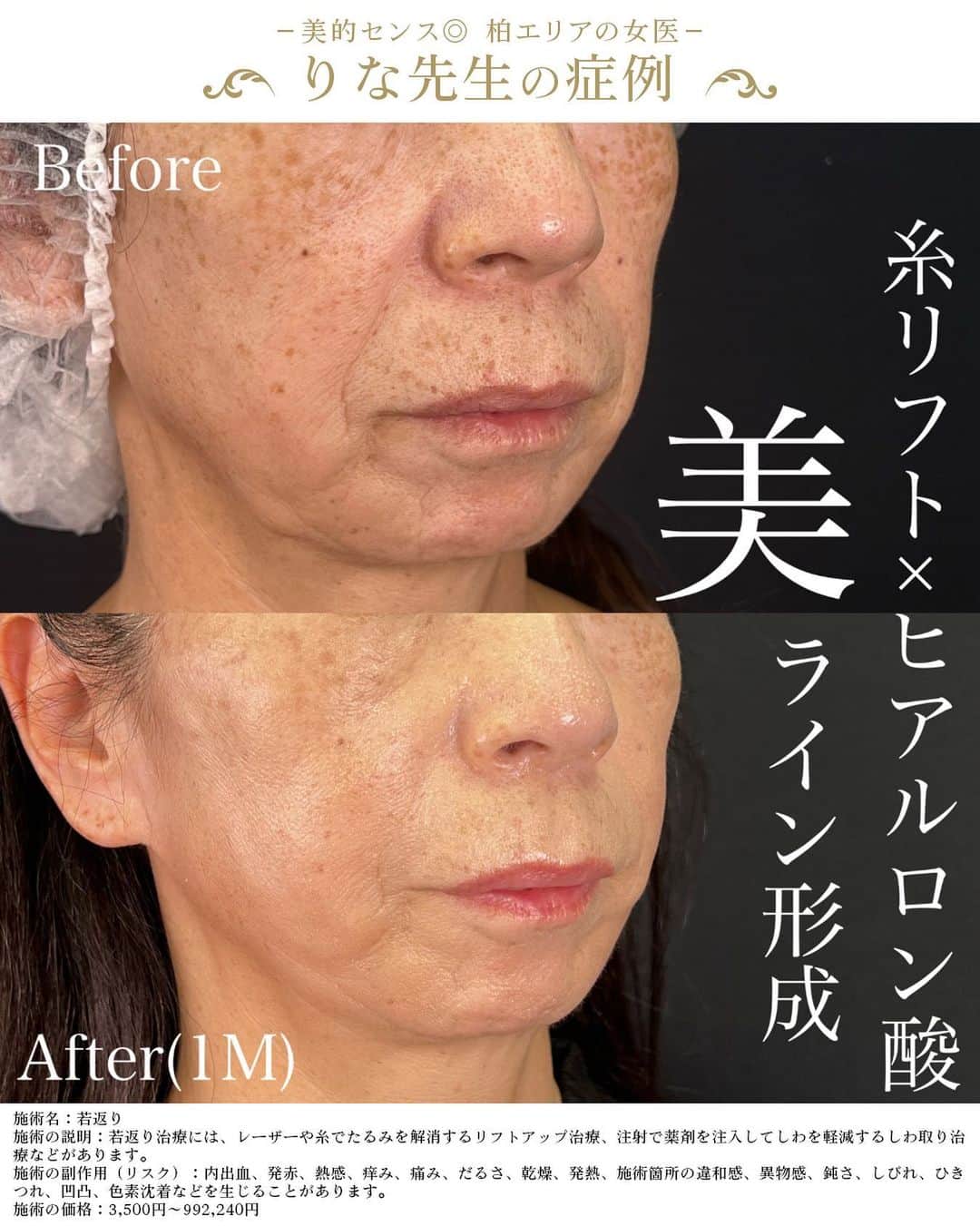 湘南美容外科 柏院さんのインスタグラム写真 - (湘南美容外科 柏院Instagram)「【🌷.*シークレットリフト18本＋法令線ヒアルロン酸🌷.*】 "とにかく今の状態を何とか良くして欲しい！！"と来院されました。 下顔面のたるみが特に目立っていたので糸リフトでリフトアップするとともに、特に深かった法令線も改善しました✨ 凹凸のない滑らかなフェイスラインを手に入れました🌟 また老けて見えやすいのが口上のシワ。こちらもボトックスを注入しております。  ✩∗*ﾟ⋆｡˚✩☪︎⋆｡˚✩∗*ﾟ⋆｡˚✩☪︎⋆｡˚✩∗*ﾟ⋆｡˚✩☪︎⋆｡˚✩  施術名：シークレットリフト 施術の説明：柔らかく柔軟性のあるリフティング用スレッドを肌に挿入し、たるみを引き上げる施術です。 施術の副作用（リスク）：傷・疼痛・腫れ・内出血・ひきつれ・神経障害を生じる可能性があります。 施術の価格：206,000円→モニター価格106,100円(6本)  ✩∗*ﾟ⋆｡˚✩☪︎⋆｡˚✩∗*ﾟ⋆｡˚✩☪︎⋆｡˚✩∗*ﾟ⋆｡˚✩☪︎⋆｡˚✩  興味のある方はお早めにご相談ください！お悩みを伺い、適切な本数と種類を提案させていただきます。 お待ちしております♡  湘南美容クリニック 藤井 里奈  🌸湘南美容クリニック柏院🌸 JR常磐線柏駅 南口より徒歩3分　Day Oneタワー 2階 診療時間　10:00～19:00  #糸リフト #アンチエイジング #糸リフトといえばりな先生 #若返りといえばりな先生 #りな先生 #りなてぃ先生 #湘南美容クリニック #湘南美容外科 #小顔 #花嫁美容 #柏糸リフト」6月17日 19時28分 - sbc_kashiwa