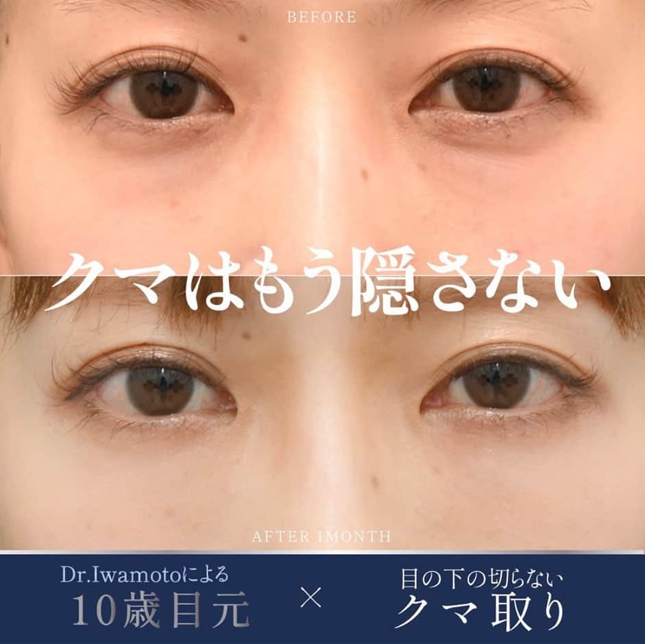 山本明果のインスタグラム：「⠀ ⠀ ⠀ ⠀ クマ取り🐻 （伝えたい事多すぎて長文） ⠀ ⠀ 4月にクマ取り手術をしました。 今回 @sbc_toyama さんでモニターでさせていただいたので、料金気になる方は直接ご相談いただくのをオススメします。 とても丁寧にお話し聞いてくださるし、ベストな方法を提案していただけます。 ⠀ ⠀ あまりクマは無かったので、やるか迷うレベルだったようなのですが、目元は年齢が出やすく、個人的に気になったのでお願いしました。 ⠀ ⠀ 結果、目元がパッと明るく、脂肪注入もしていただいたのでふっくらしてやってよかったです。 ⠀ ⠀ 手順としては、クマの原因となる眼窩脂肪除去（3枚目のですが少なめ） 太ももの付け根から脂肪を取って注入。 ⠀ ⠀ 麻酔はするのですが、私は寝る事なく意識ばっちりありました。 もちろん痛くはない。 ⠀ ⠀ 2枚目が術後当日の顔です。 痛そうだけど麻酔切れても全く痛く無かったです。 むしろ脂肪を取った太ももがびっくりするくらいの内出血。 こちらのほうが痛かったけど、筋肉痛のひどいくらいが一週間ほど。 結構余裕でした。 脂肪取ったとこが馴染むように着圧スパッツ履いてました。 ⠀ ⠀ 顔の方は、内出血が1週間ほど。 注入した脂肪が馴染むのは2.3ヶ月かかるようですが、2ヶ月経った今、もうわからないほど馴染んでいます。 ⠀ ⠀ ついでに、もともと二重ではあるのですか、起きた時に日によって奥二重や三重になる右目も埋没法で止めてもらいました。 ⠀ ⠀ 数分糊付けしておけば二重になるのですが、やってもらったことによりストレスフリー。 これは完全にやってよかった！  @sbc_iwamotoyuki 先生にお願いしましたが、とても上手で満足のいく結果に。 気になる方はぜひカウンセリングを。 ⠀ ⠀ ご質問はストーリーで受け付けますね。 ⠀ ⠀」