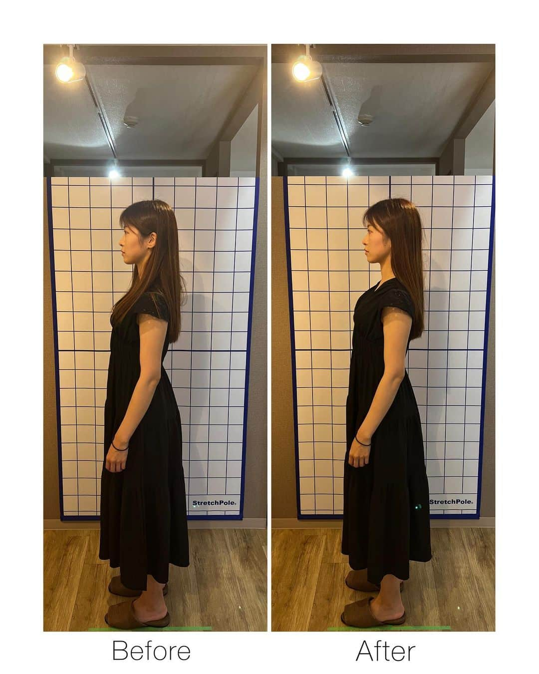 畑中香澄さんのインスタグラム写真 - (畑中香澄Instagram)「🦴🦴 最近ずーーっと首と背中が痛くて、 気になってたブリッジ接骨院さんで施術してもらったら かなり楽になった😭😭✨✨  ストレートネックつらすぎ。。 抱っこで腰と肩やられてて、肩は特にやばいと笑笑  4枚目にBefore Afterあるんだけど、 顔が前に出ちゃってるの治ってる✨  肩甲骨も動くようになったから可動域が広がって、 歩くときの身軽さがすごい😭✨  巻き肩改善！！！  @bridge_seikotsu1216 さんありがとうございました！  子供預けられる日にまた行こうと思います🥺 . . . #猫背矯正 #船橋整体 #船橋整骨院 #船橋肩こり #船橋頭痛 #ブリッジ整骨院 #女の子ママ #産後ケア #腰痛 #肩こりやばい #肩甲骨はがし PR」6月20日 12時45分 - djkasumi_jpn