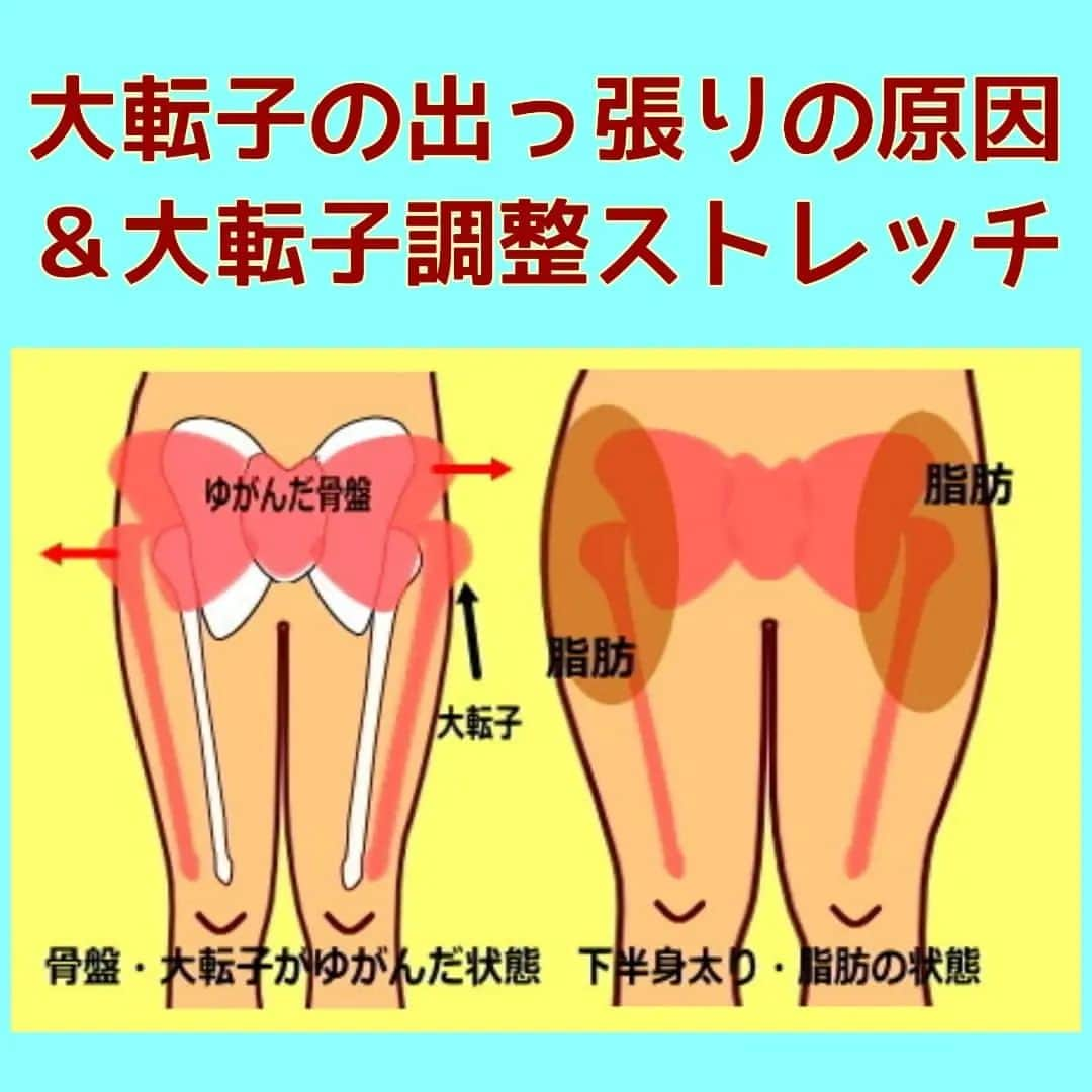 中目黒整体レメディオ 院長　渡邉潤一のインスタグラム：「大転子のゆがみは下半身太りを引き起こす原因の一つです。 そこで、ここではこの大転子のゆがみについてお話していきます。  まず、骨盤の横の出っ張りである大転子は、よく間違われますが骨盤ではありません。 大転子は太ももの骨（大腿骨）の一部で、股関節を形成している部分の反対側に位置します。   大転子が横に出っ張ってしまう、骨盤の横が広がる現象は、骨盤（仙腸関節）のゆがみに対して必ず連動して起こります。  大転子がゆがんでいるとき、骨盤（仙腸関節）はゆがんでいて、外側にひらいています。  これは仙腸関節を形成している仙骨の関節面の形により、その関節面の上を寛骨がスライドしたことによっておこります。  骨盤がゆがみ広がったことで、重心バランスは外側にズレます。それを太ももの骨（大腿骨）が外側から支えようと動いたことで大転子が外側に張り出します。  この時、単純に外側に出っ張るのではなく、必ず、股関節を中心に大腿骨が内側にねじれながら外側に出ます。 大転子が出ている方に膝や足首にねじれがあるのはそのためです。  また、大転子の出っ張りは、股関節の捻れに密接に関係します。   大転子がゆがんだことで股関節まわりの筋肉の代謝が下がり、骨盤の外側にお肉がつき、骨盤が横に張ったような状態になります。 太ももの外側では、筋肉が硬くなり内側からふくらむようにして太くなります。  また、大転子にはお尻の筋肉がくっついているので、大転子がゆがんだことでお尻の筋肉は引っ張られ、お尻全体が大きく広がりたれてしまい、お尻の形が四角くピーマンのような形になってしまいます。  このように、骨盤がゆがみ大転子が出るということは、これだけ多くのことが引き起こされ下半身が太くなっていくのです。 . . ーーーーーーーーーーーーーーーーーーーーー  💮施術のご案内💮 中目黒整体レメディオ：骨盤・美脚コース 施術をご希望の方は、はHPの予約フォームか、 お電話（0357735977）にてご連絡ください。  ーーーーーーーーーーーーーーーーーーーーー . . #大転子 #大転子矯正 #o脚矯正 #x脚矯正 #膝下o脚 #XO脚 #骨格矯正 #骨盤矯正 #産後骨盤矯正 #下半身太り #下半身痩せ #X脚ストレッチ #反り膝  #反り腰 #骨盤の歪み #整体 #レメディオ #姿勢矯正 #中目黒整体レメディオ #整体サロン #骨格診断 #大転子ストレッチ」