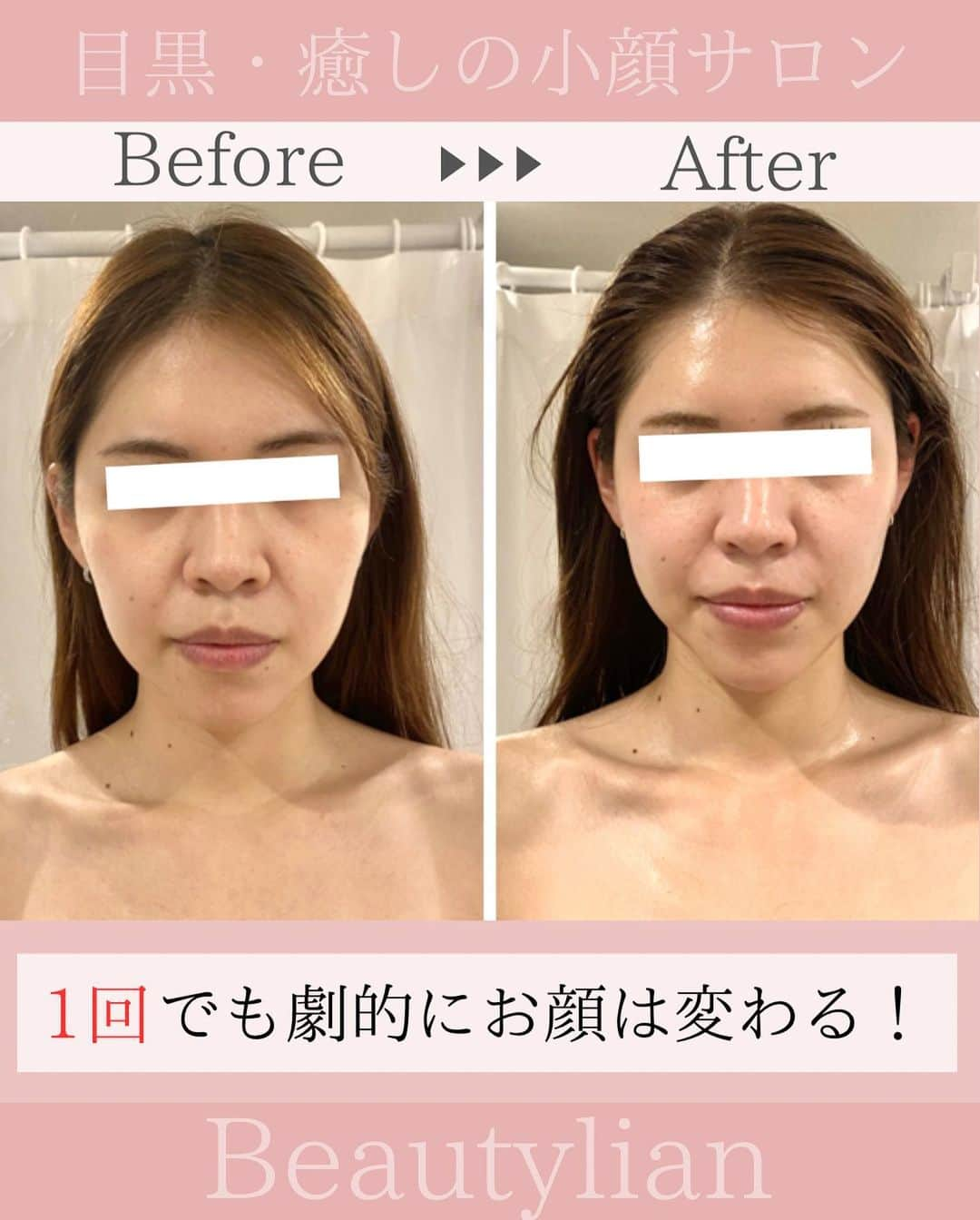 Eternal Total Beauty Salonのインスタグラム：「.  【小顔になるだけではない♪】  小顔矯正と言っても、ただお顔が小さくなる だけではありません！ ⁡ ◎歪みや左右差が整う ◎トーンアップする ◎リフトアップする ◎バランスが良くなる ◎首が長くなる ⁡ などなど他にも沢山変わる所があります♪ ⁡ ⁡小顔以外にも1回の施術の中で 色々な事をやっていくので、 ただ小顔になるだけでは 得られない変化があります☺️  お顔を変えるだけではなく サロンに来てくださってる 時間は身も心も解放して  今より自分のお顔が好きになり 「また明日から頑張ろう！」と 活力になってもらえると嬉しいです🤍  _  【小顔効果倍増なペース】 ＊初回から含めて3回目までは週1から空けても2週に1回のペースを推奨しております。 最初に土台を作り戻りにくく定着させる為です。 ⁡ ご新規様は3回分のご予約をオススメ致します。トップページのHPから承っております🙇‍♀️ ⁡ ⁡ ⁡ ＊＊＊＊＊＊＊＊＊＊＊＊＊＊＊＊＊＊＊＊ ⁡ ⁡ 小顔矯正/インディバ ⁡ ⁡ 営業時間　11:00〜20:00(18:30最終受付) ⁡ 定休日　不定休 ⁡ ⁡ ご予約はトップページのURLから🙇‍♀️✨ 【@beautylian_kogao】 ⁡ ＊＊＊＊＊＊＊＊＊＊＊＊＊＊＊＊＊＊＊＊ ⁡ #小顔矯正東京 #小顔矯正 #小顔矯正サロン  #かおやせ #小顔になりたい #リフトアップ #プレ花嫁東京 #花嫁美容 #小顔エステ  #たるみ解消 #ほうれい線解消 #目黒小顔矯正」