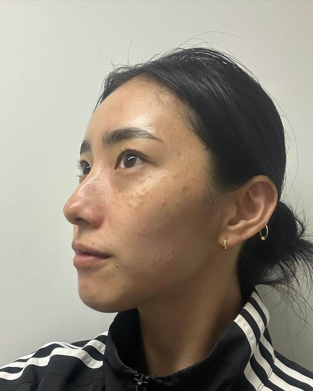 中田クルミさんのインスタグラム写真 - (中田クルミInstagram)「見事なチョコチップ顔🍪 しばらく仕事が空いたので、思い切って @nexus_clinic でシミそばかすを撃退してきました。 ・ピコスポット ・ピコトーニング ・エレクトロポレーション この3つを施術して、内服薬をまずは3ヶ月続けます。 肌診診断機で肌年齢22歳と言われましたが、浮かれてる場合ではありません。見てくださいこの隠れシミの数々を。 私は本気です。美容医療大好きマンです。  ちなみに今術後2日目で、直後の写真は4枚目です。 チョコチップ顔からの変化が楽しいので、毎日写真撮って記録してます。後日まとめてアップしたら参考になるかな🤔 酒井先生 @dr.tomoko_antiaging ありがとうございました&これからもよろしくお願いします！」6月21日 16時17分 - kurumi_nakata
