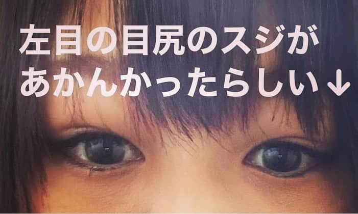 小野さゆりさんのインスタグラム写真 - (小野さゆりInstagram)「投稿が断片的で、現在美容の為に二重手術してると勘違いされているので改めて紹介させてください💦  加齢で40歳以降ほとんどの方がなる可能性があるので、瞼で目が見えずらく肩こりや頭痛がひどい方はセルフチェックしてみてください✨  眼瞼下垂かもってsnsに投稿してから、本当にたくさんの方やお友達から実は私も俺も眼瞼下垂で手術したよって連絡いただき、ありがたい勇気や情報をもらいました✨ありがとうございました🥺  眼瞼下垂は、まぶたが下がって見にくくなる病態です。 上まぶたを上げる筋肉の力が弱くなったり、その付着部である腱けんが弱くなったり、はがれたり、穴が開いたりすることです。 症状は見にくさの他、肩こり、頭痛、疲れる。 私だけかもだけど、涙が止まらなかったり気圧の変化に異常にやられるようになりました。  さらに、瞼のミューラー筋は交感神経で動く筋肉なので、奥歯を常に噛みしめ常に交感神経を興奮させる状態の交感神経刺激症状で、めまい・うつ・不安・便秘・冷え性・不眠・慢性疲労など様々な症状を引き起こす可能性あるとも言われています。  私は8ヶ月前から瞼の垂れや膨らみが悪化していき、視界が悪くなり、頭痛や肩凝り眼痛に悩まされていた為、眼科や内科、産婦人科に行っても異常なしな為、ボトックスで瞼のトレーニングもしましたが、あまり効果がなく最終手段の手術をしました✨  瞼を切開すると、涙腺が腫れてる＋筋肉？すじ？が伸びてるかはずれてるので、修正していただきました✨手術やもろもろで約3時間。 筋肉いじるから目を開く確認が必要な為、部分麻酔のみ。 「びっくり目になってるな、もうちょい下げるか」 と何回も細かい調整が。ありがたや。  私の場合、長年のコンタクトの長時間使用や、花粉症＆アトピーもちで瞼を頻繁にこすったり、長時間のスマホ操作、瞼でなくおでこと眉毛で目を開いたり、食いしばりの癖があったり、皮膚が弛みやすい遺伝もあり、さらに老後が心配🥲（年取って再発する人も）  瞼は調べれば調べるほど、脳と繋がってるから、ストレスでなったり、脳出血の前兆だったりと、瞼の不調やべー！となります！( ﾟωﾟ；)  術後眼痛頭痛は早速なくなったので、皆様もぜひ！  デザイン指定してないので、以前と変わらないお気に入りの奥二重猫目に戻れる事を祈ってます🥲  #眼瞼下垂　#眼瞼下垂手術」6月22日 2時36分 - sayuriono0301